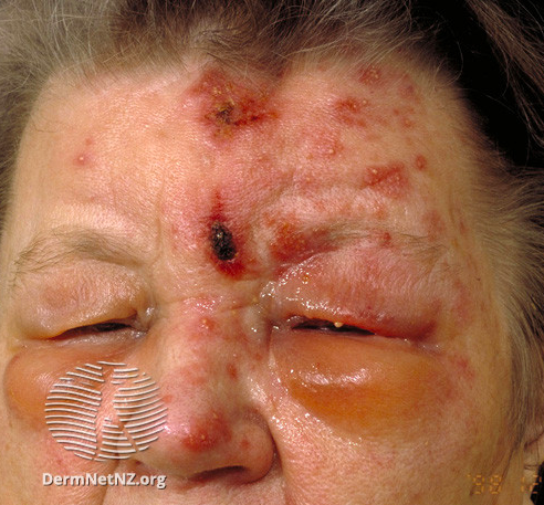 <p>Herpes Zoster Ophthalmicus with Hutchinson Sign