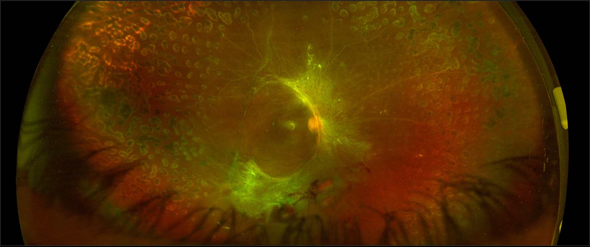 <p>Proliferative Diabetic Retinopathy. Tractional retinal detachment.</p>