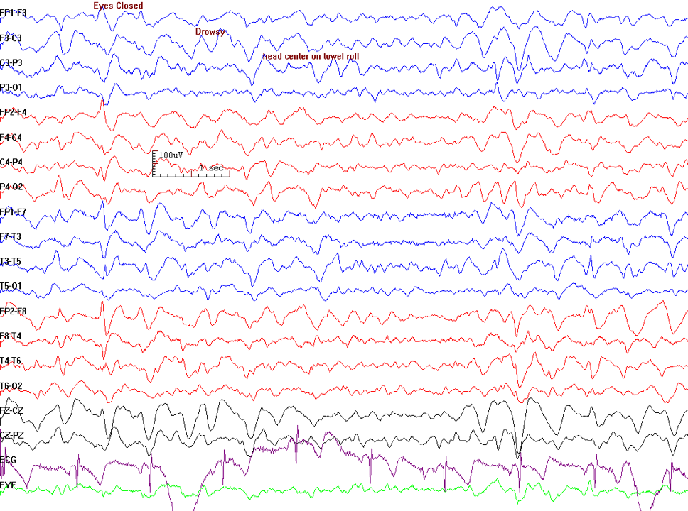 Triphasic waves