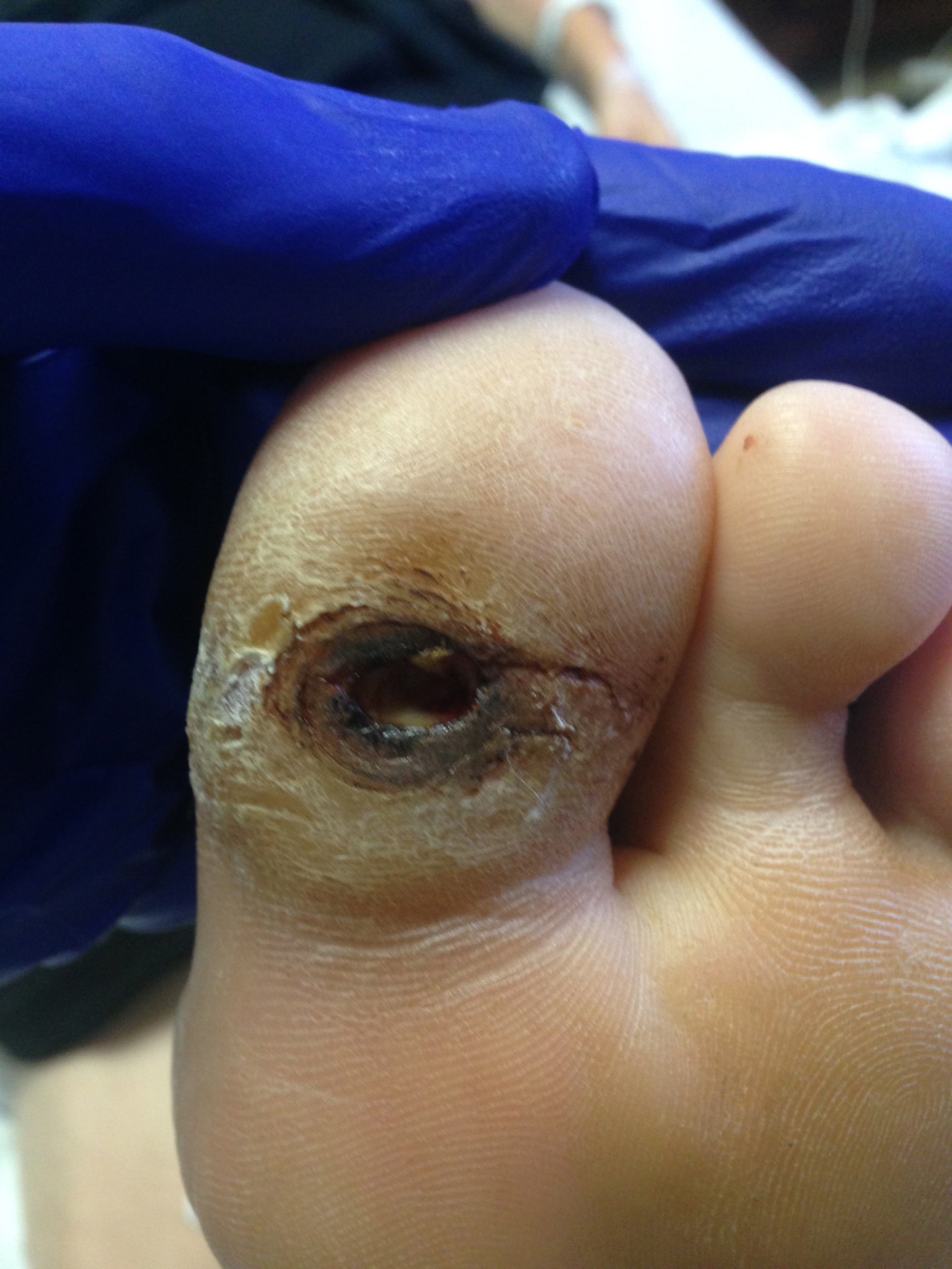 Neuropathic Ulcer
Located beneath great toe in a patient with diabetes and peripheral neuropathy.