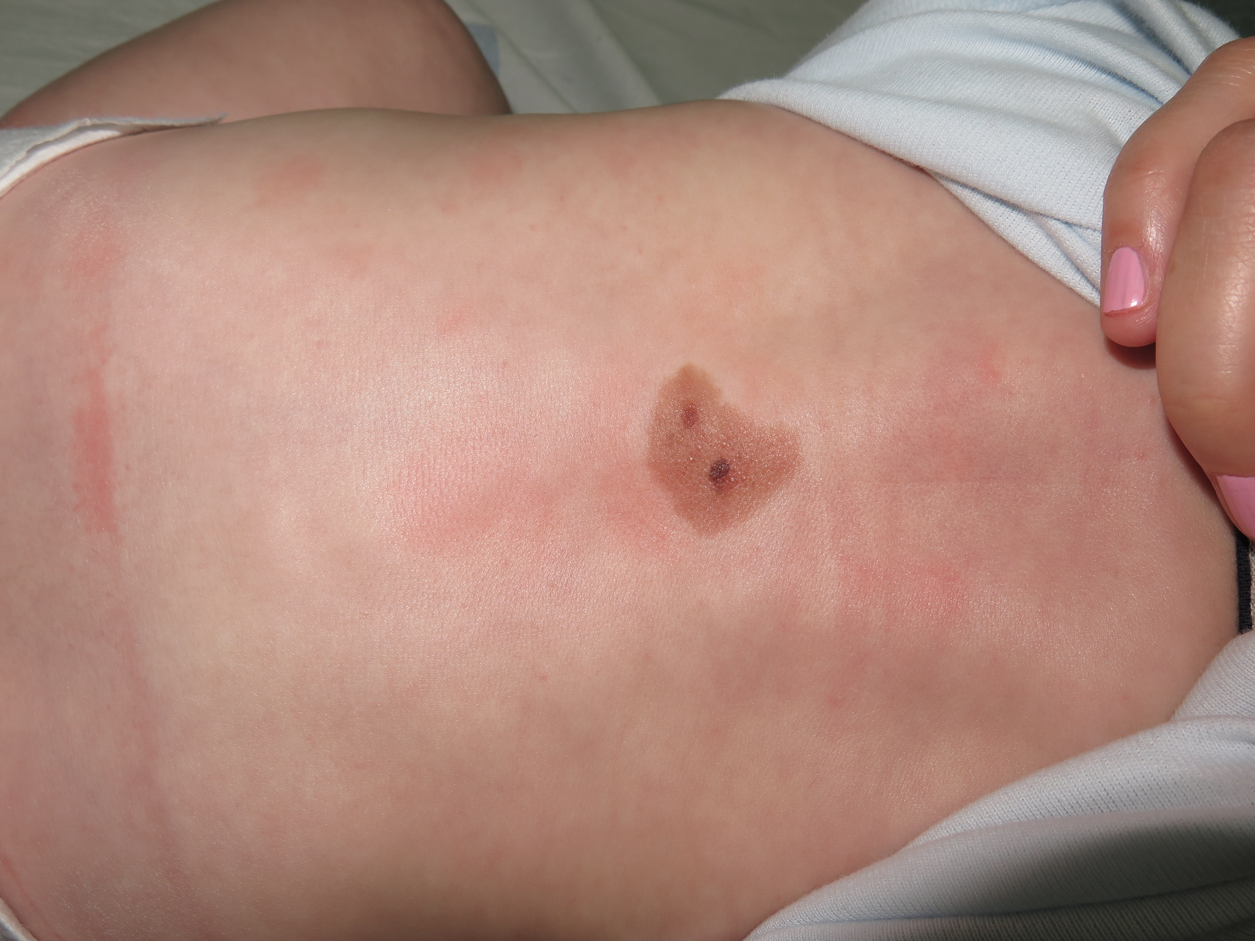 Medium-sized congenital nevus on a newborn's back