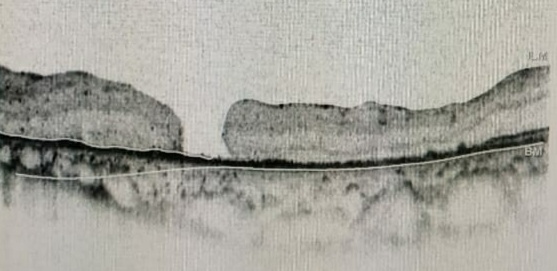 SD-OCT (macular scan) showing epiretinal membrane (ERM) with full-thickness macular hole (FTMH)