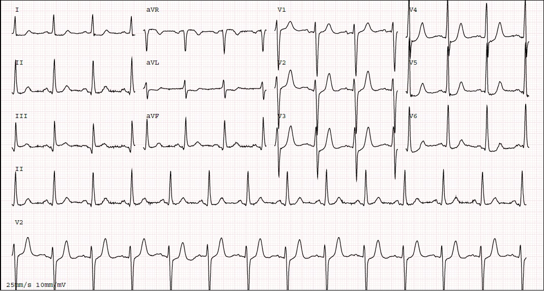 Electrocardiogram depicting the De Winter pattern