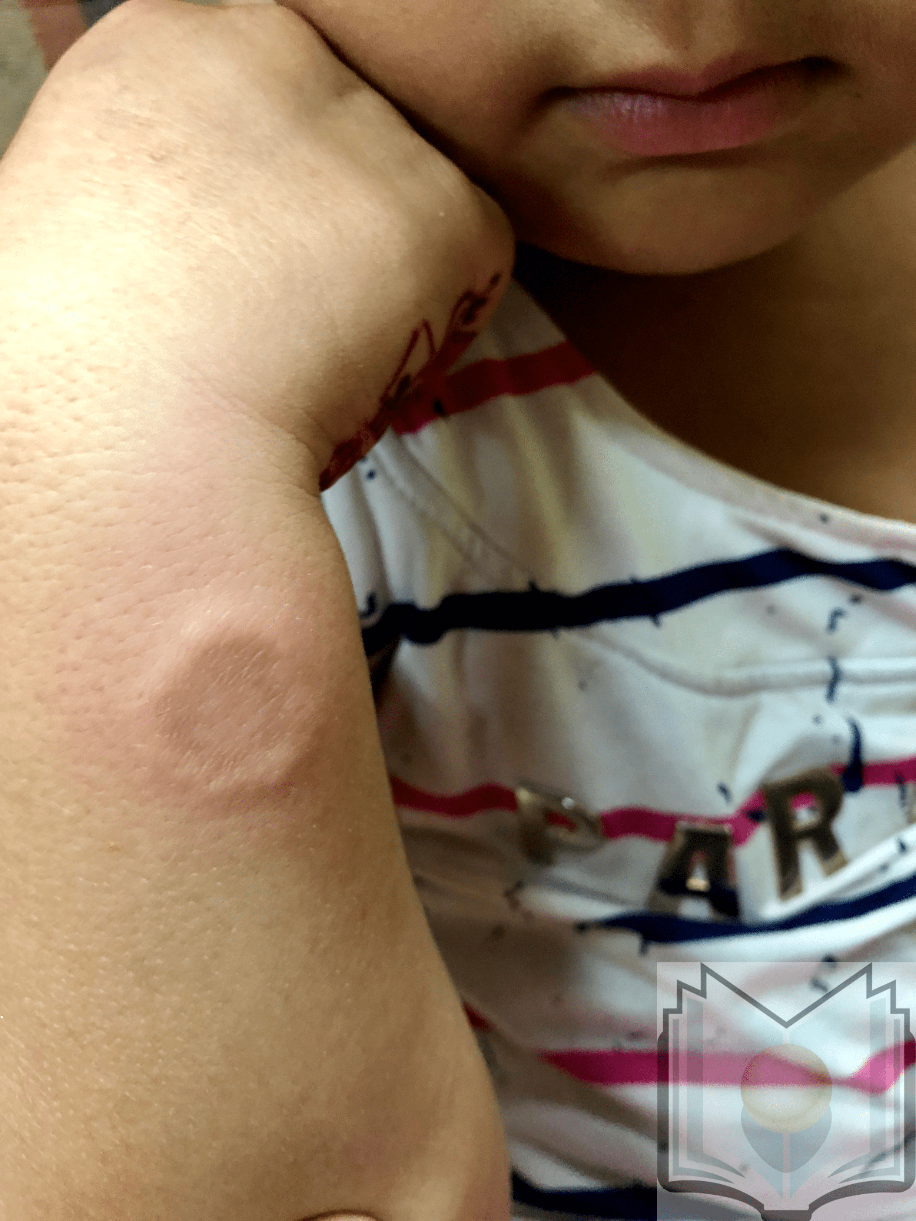 Granuloma Annulare Child