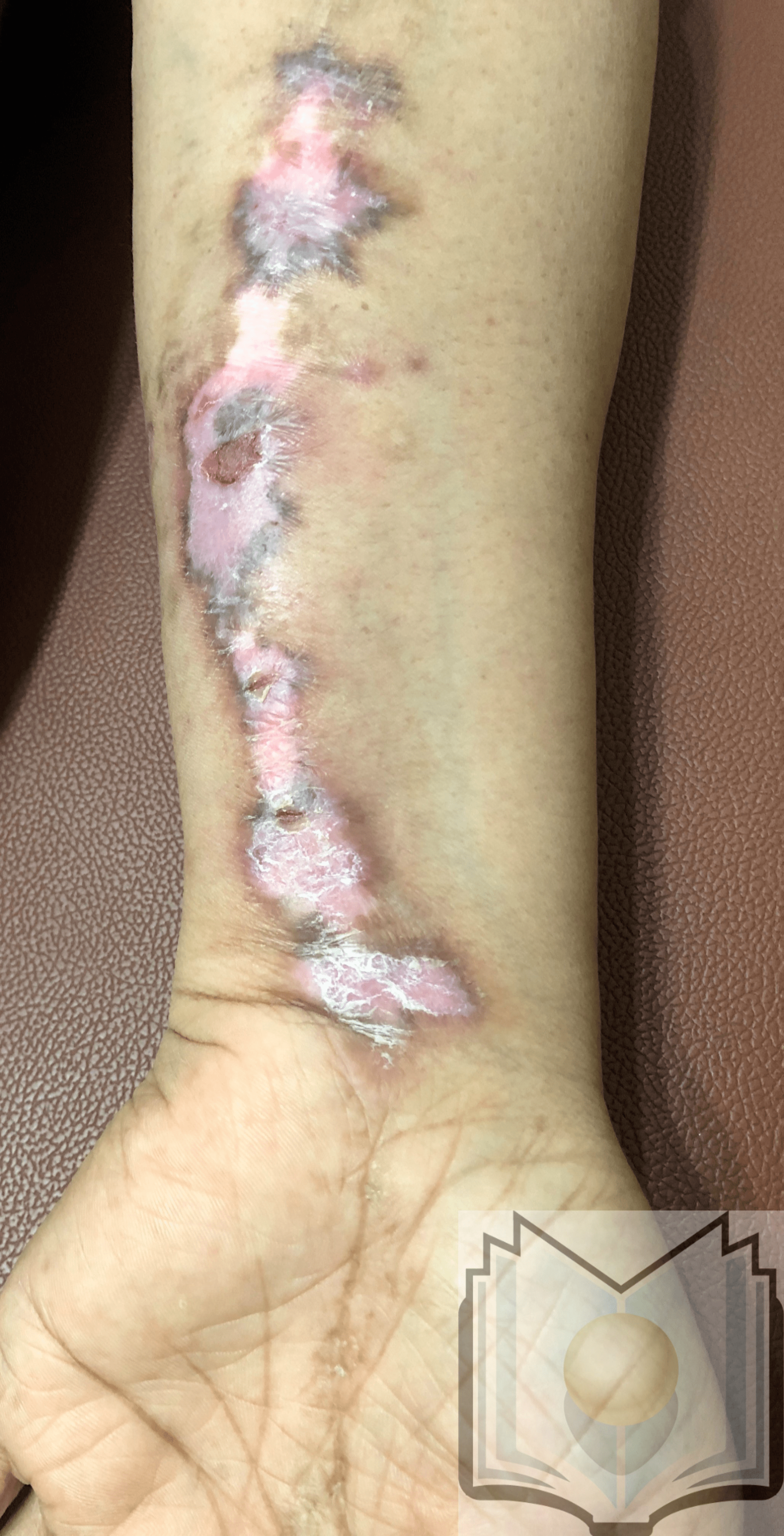 Linear Discoid Lupus Erythematosus