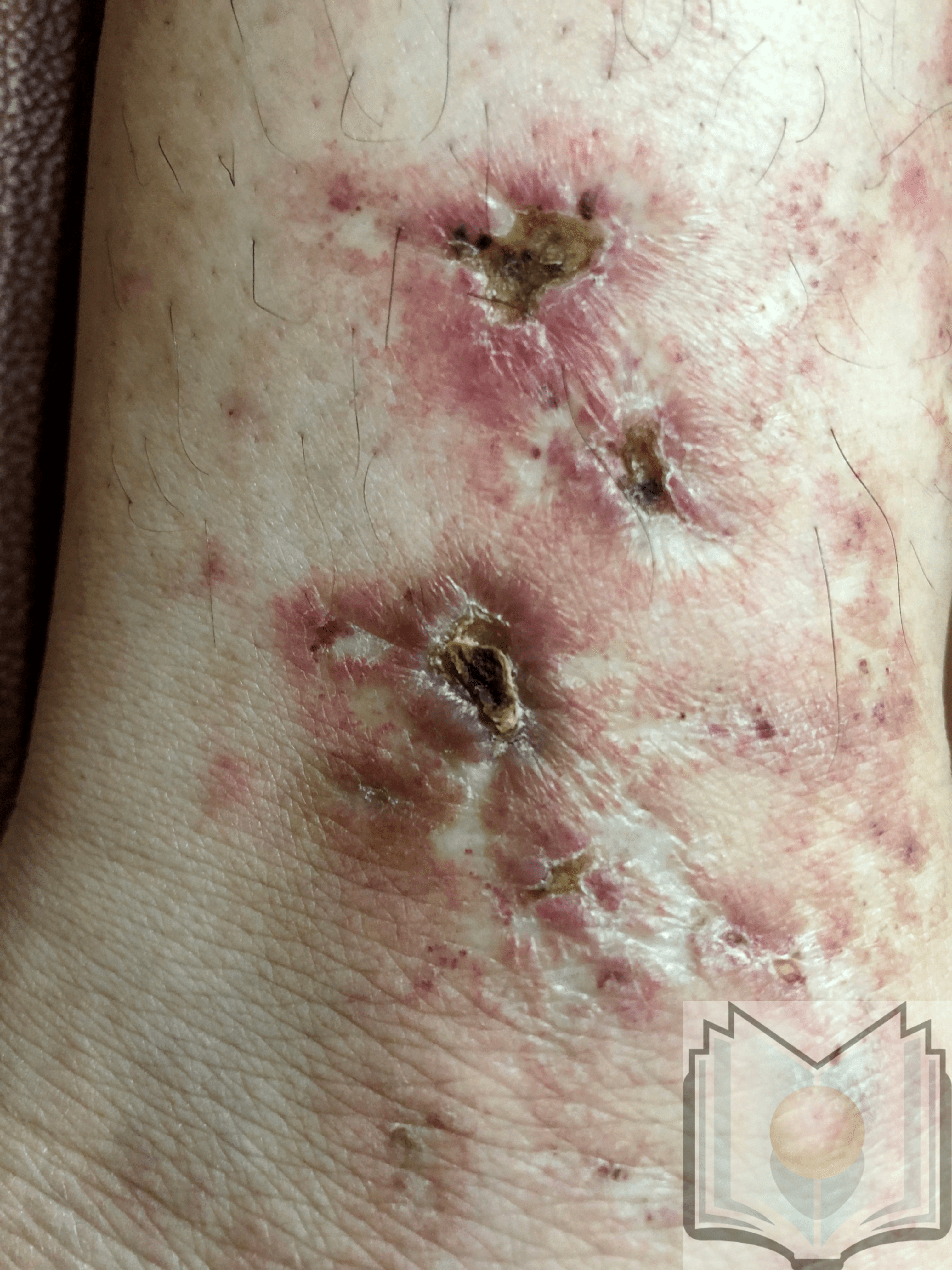 Livedoid vasculitis