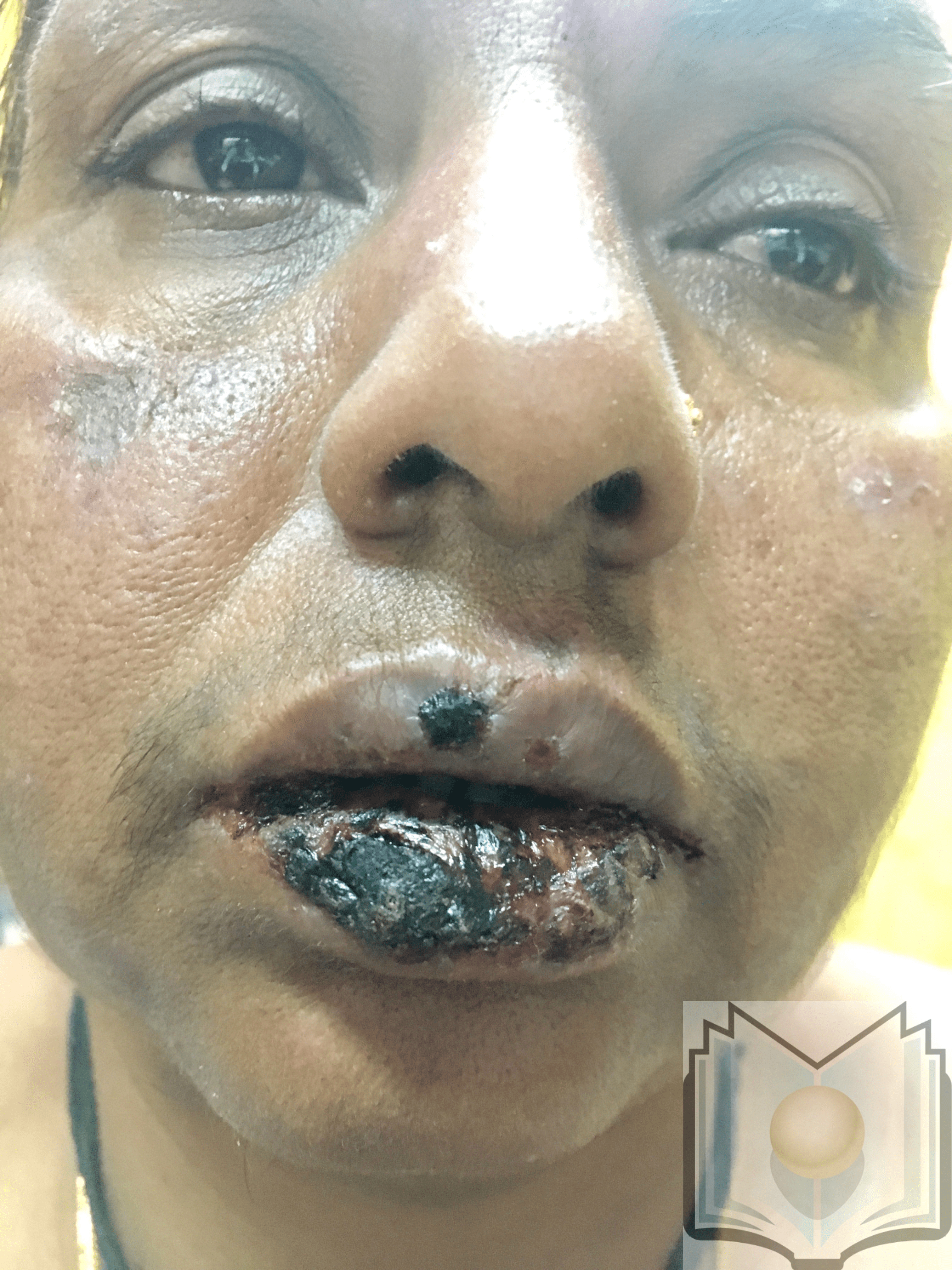 Oral Lesions of Erythema Multiformes