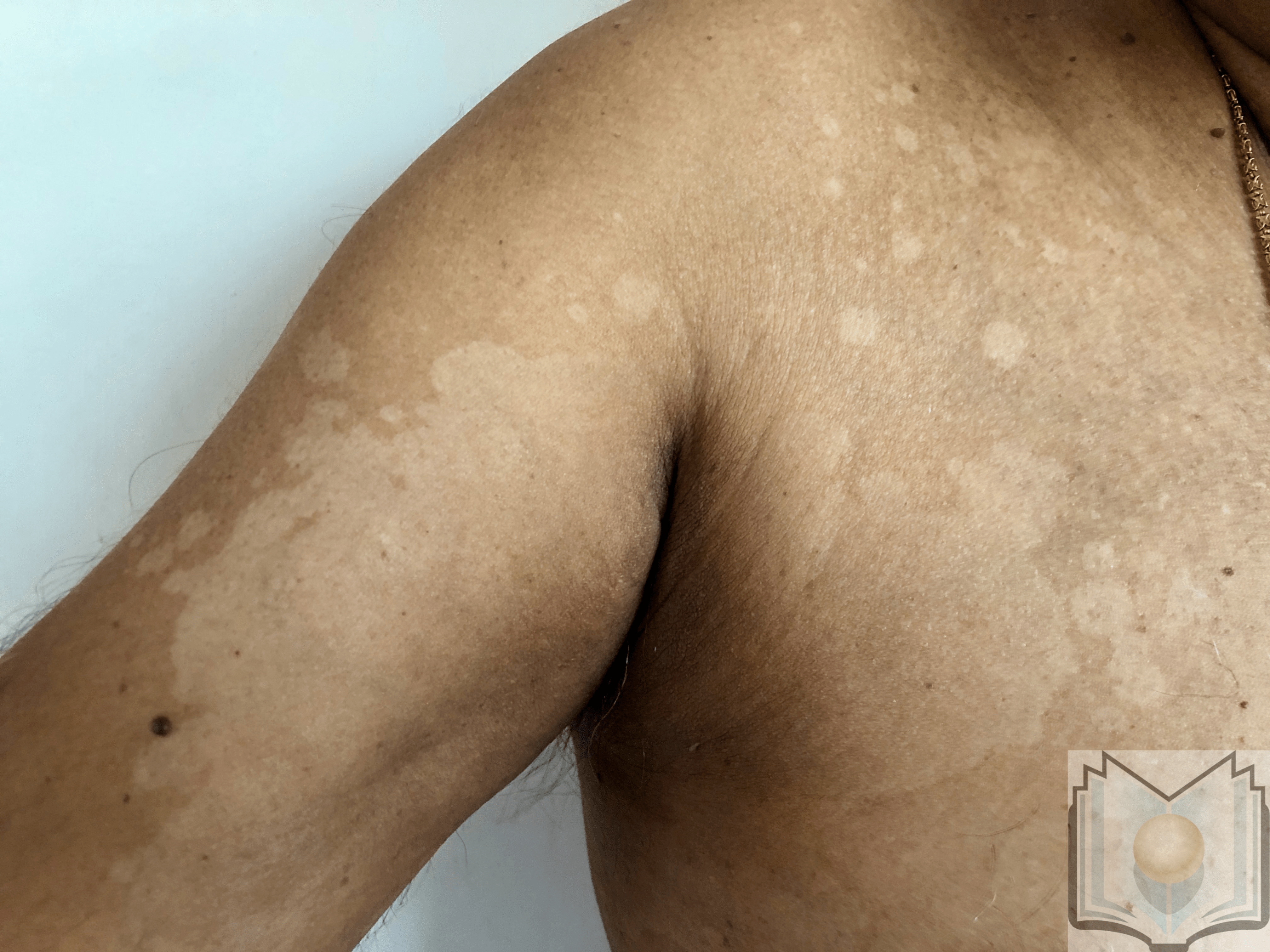 Pityriasis Versicolor