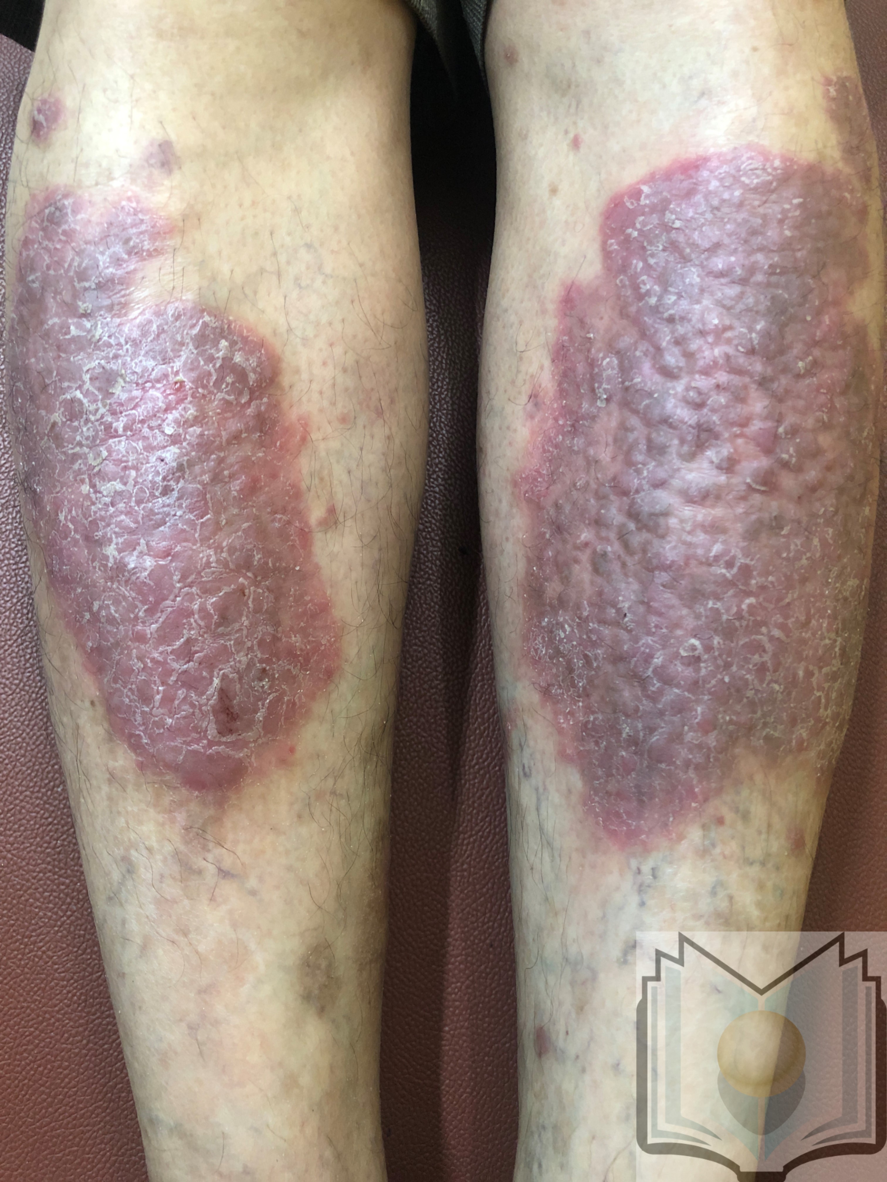 Psoriasis, on bilaterally on lower leg