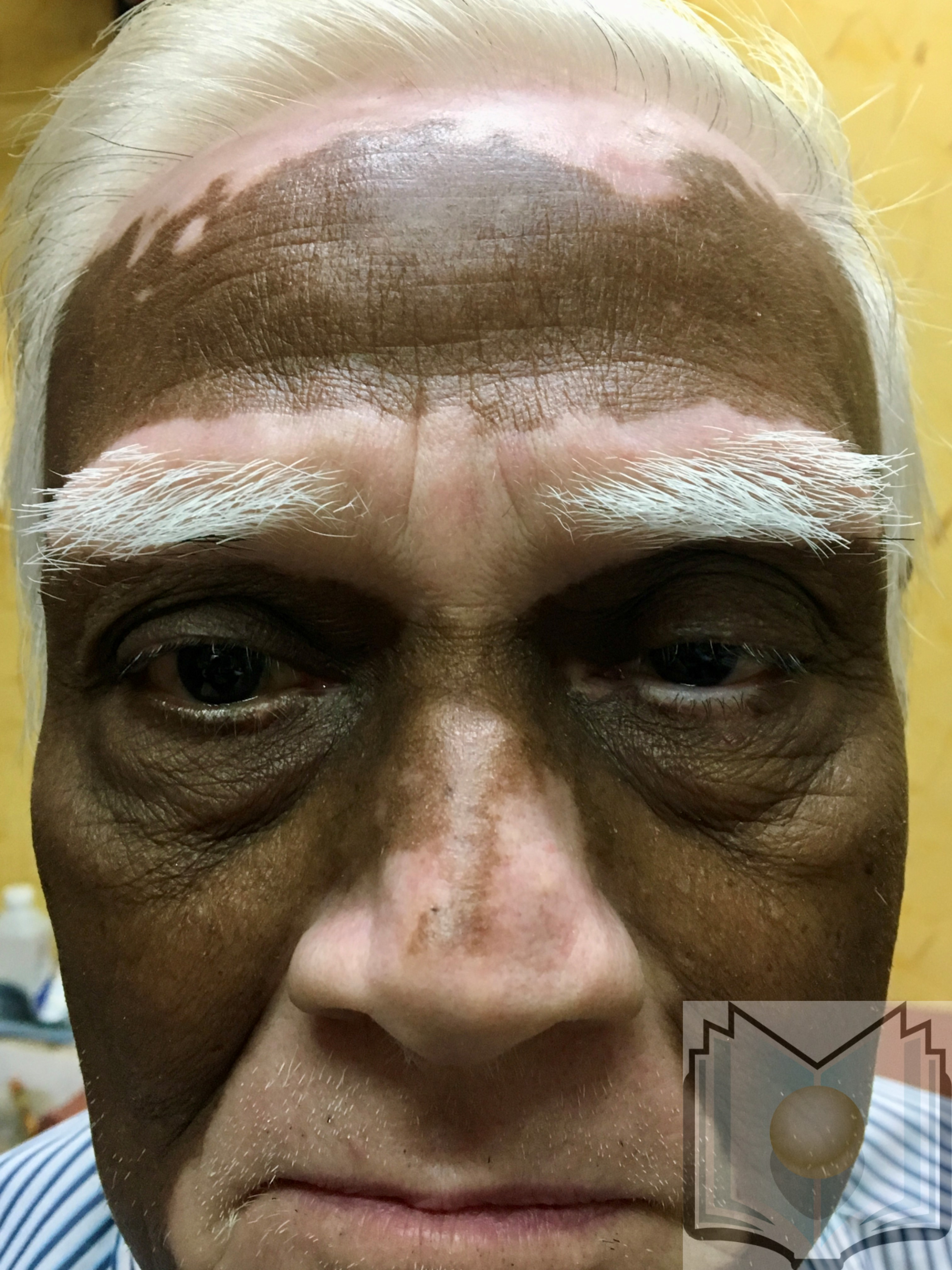 Vitiligo, Facial