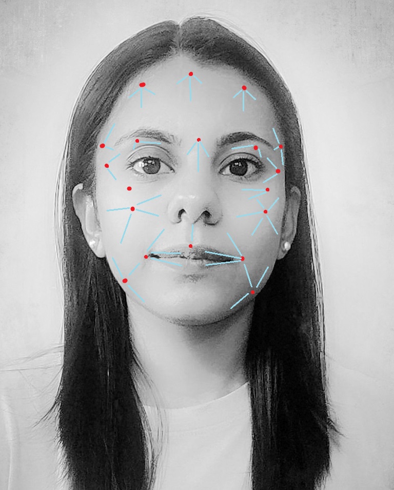 Most common injection sites and direction for fat grafting on the face