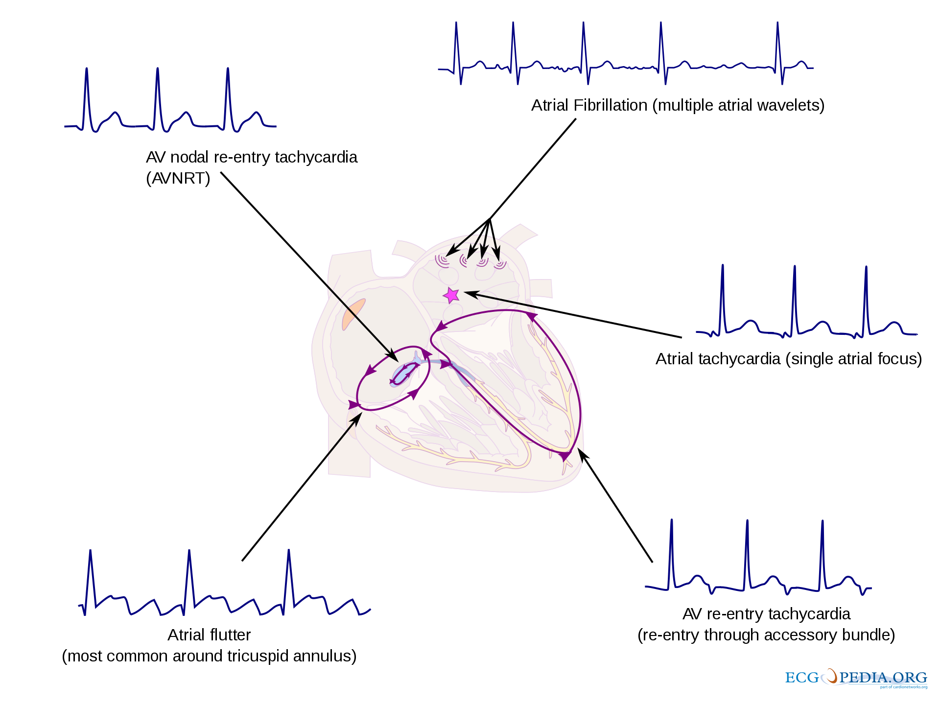 SVT overview