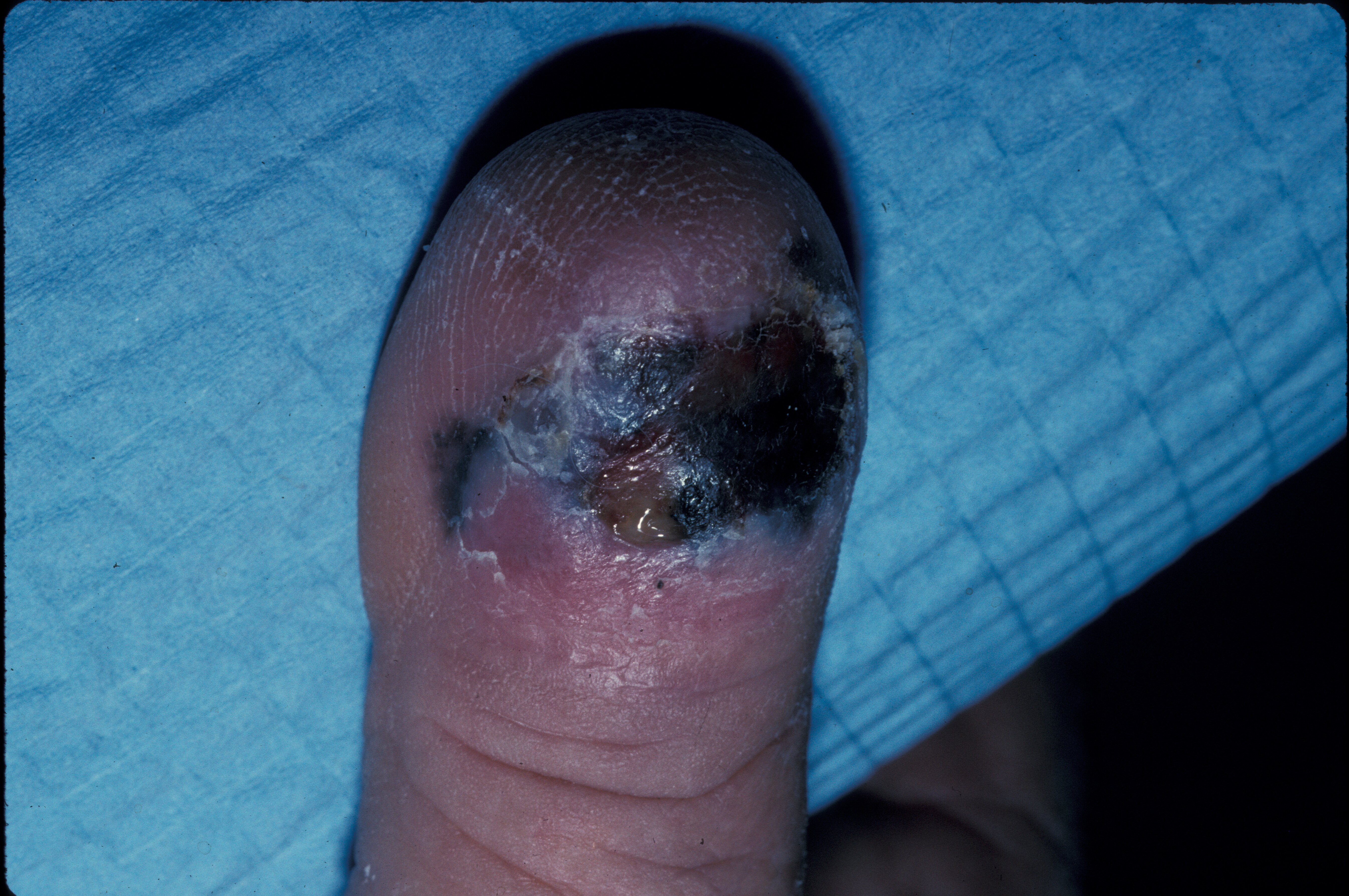 <p>Clinical Photo of an Ulcerated Acral Lentiginous Melanoma on the Dorsal Aspect of a Toe.</p>