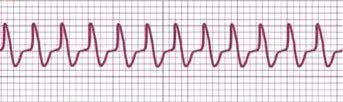 AVRT ECG strip