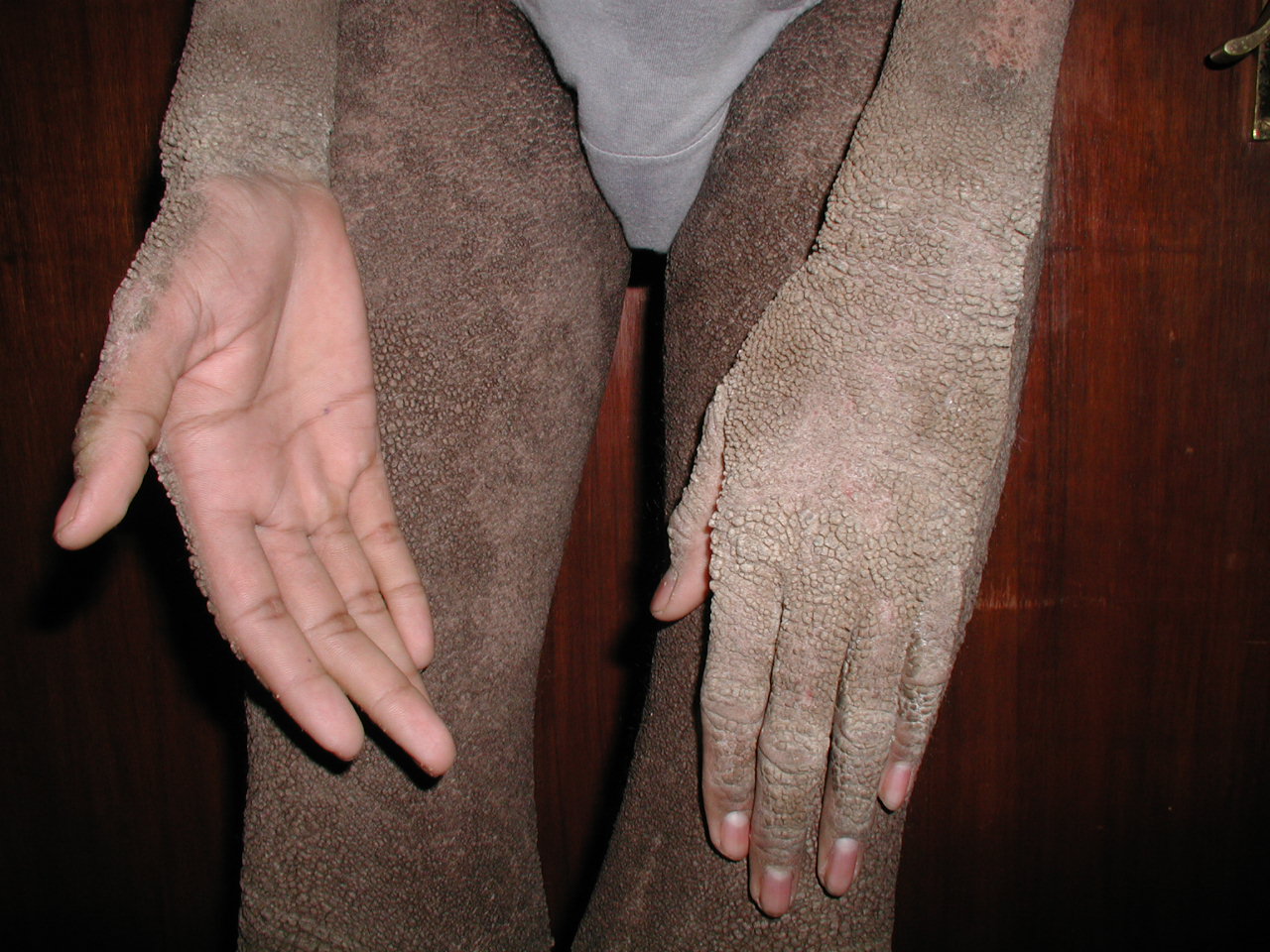 Epidermolytic Hyperkeratosis