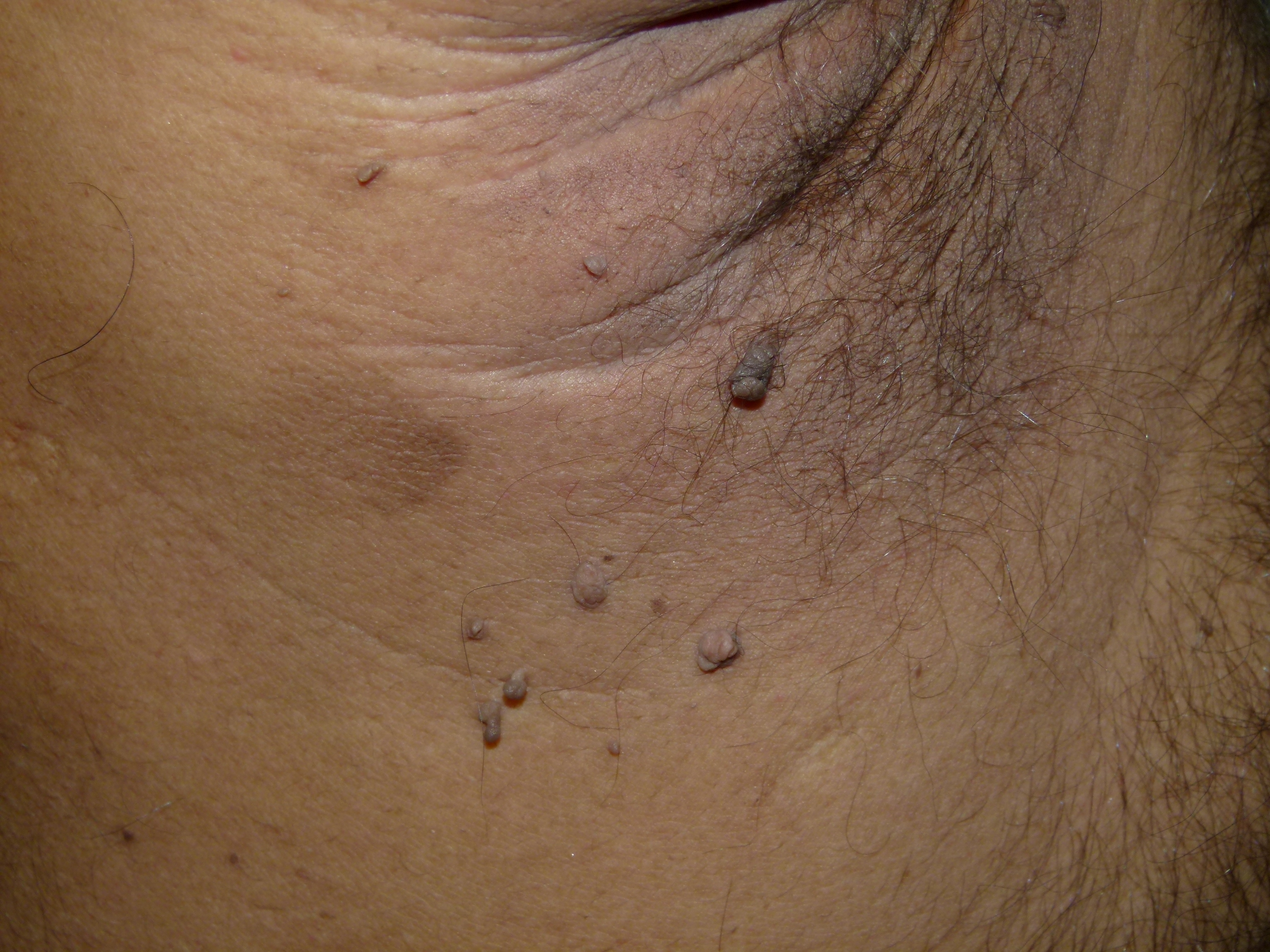 Skin Tags