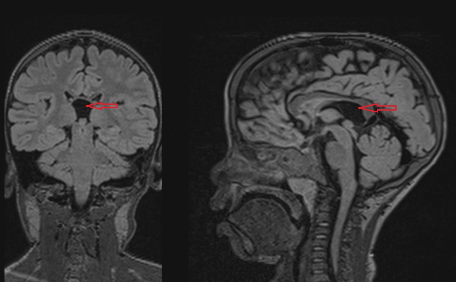 <p>Coronal and Sagittal FLAIR: Cavum Veli Interpositi</p>