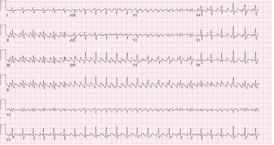 <p>Atrial Flutter</p>