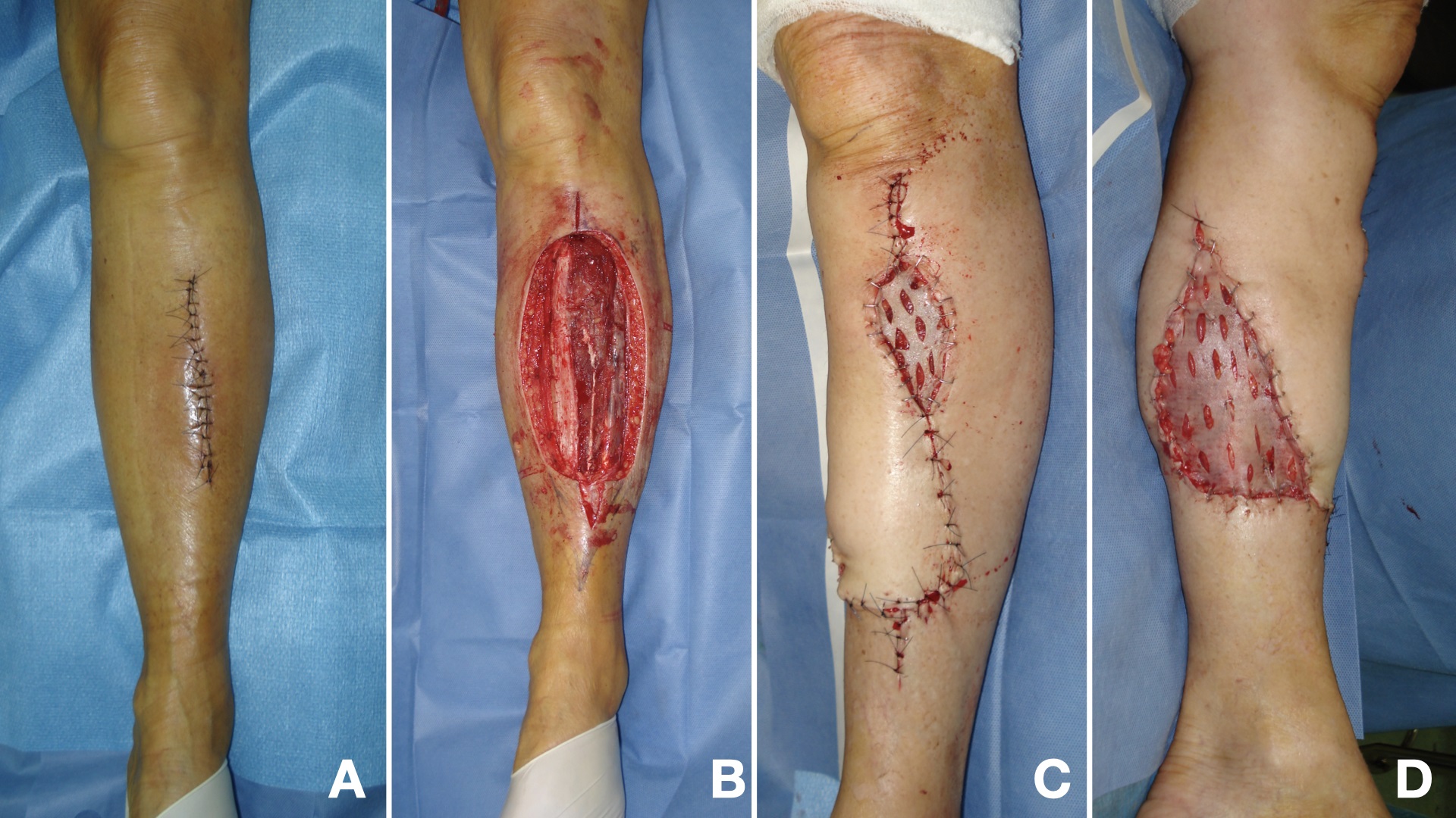 <p>Medial Fasciocutaneous Flap