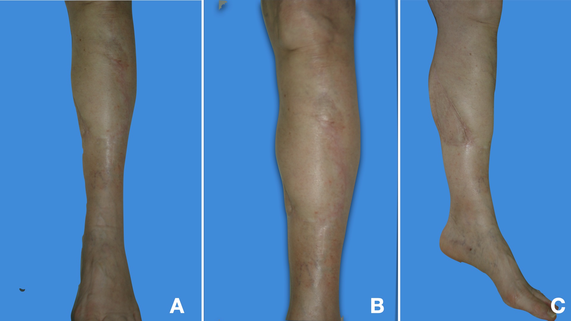 <p>Medial Fasciocutaneous Flap Follow-Up. Images A, B, and C show the flap at a 2-year follow-up.</p>