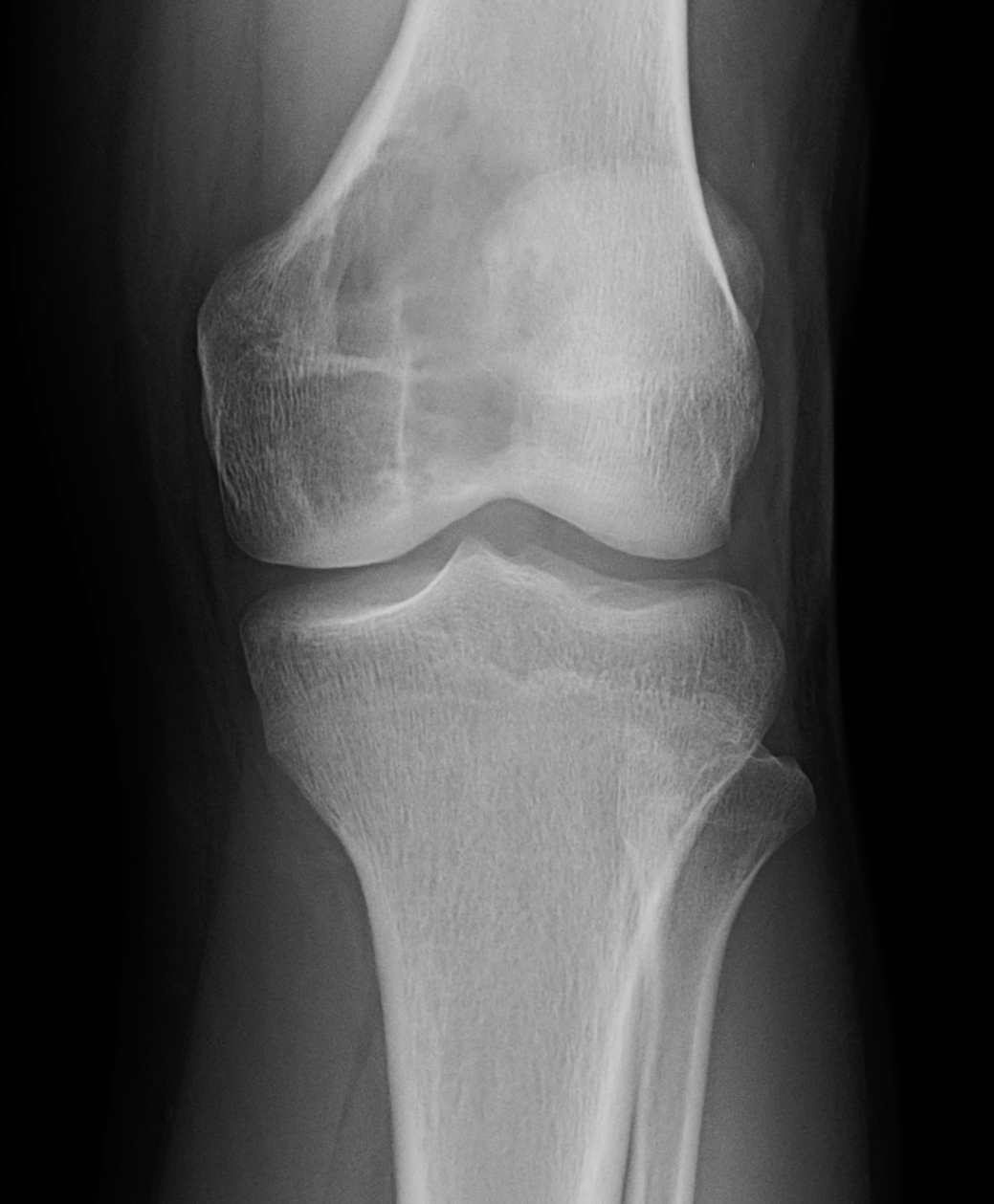 Radiographic image of a lytic lesion primarily centered at the epiphysis.