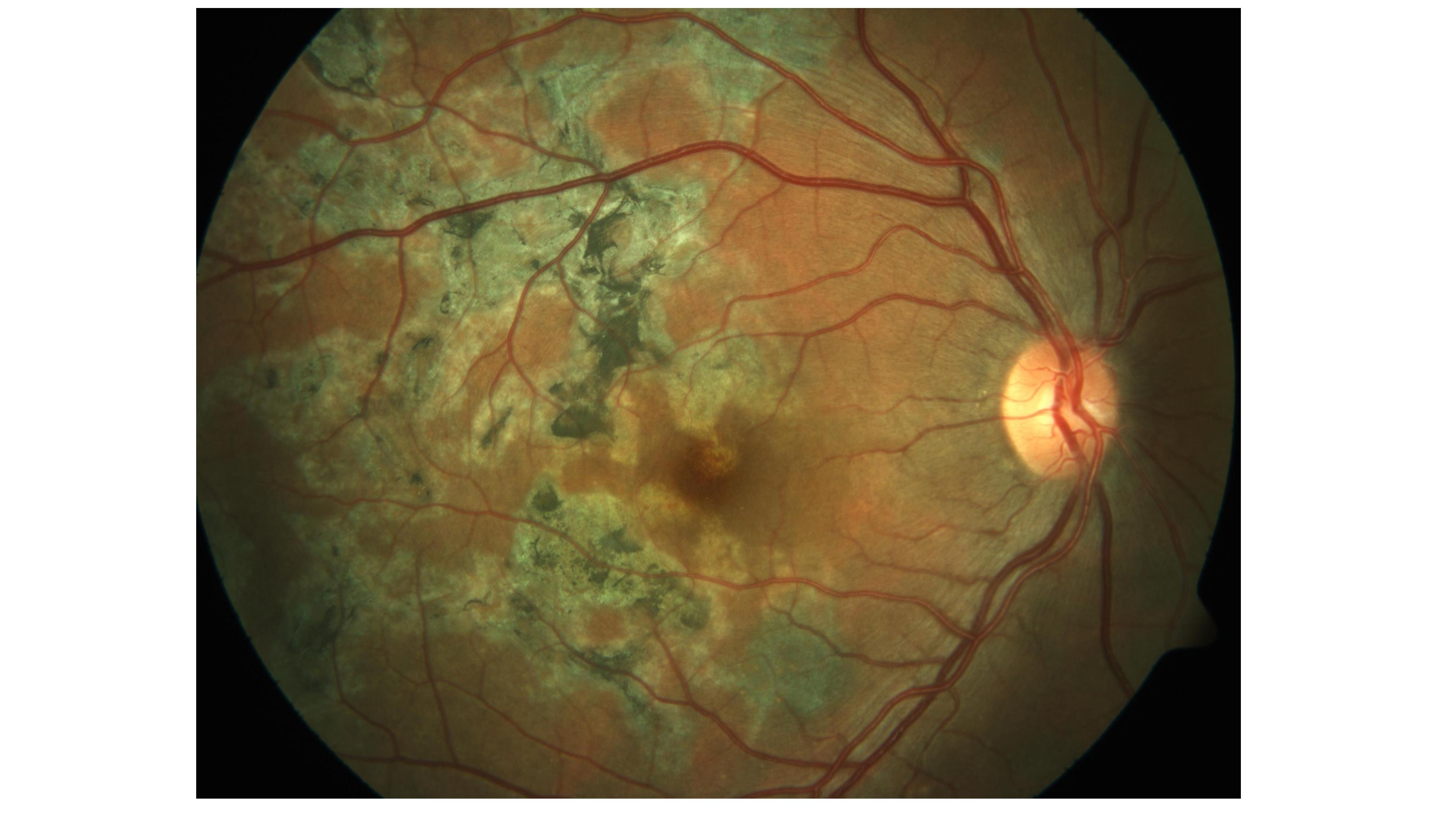 Multifocal serpiginoid choroiditis. Note the irregular multifocal pigmented choroidal lesions in the macula.