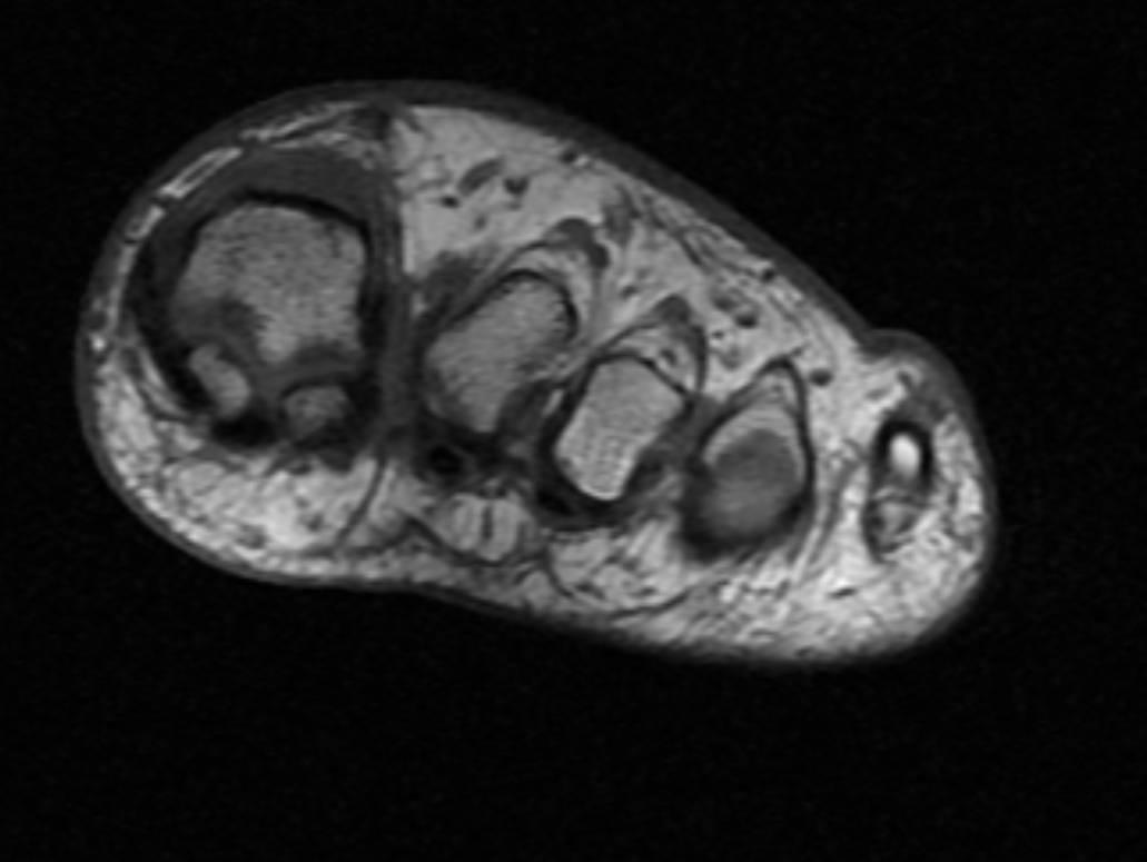 <p>MRI Morton Neuroma