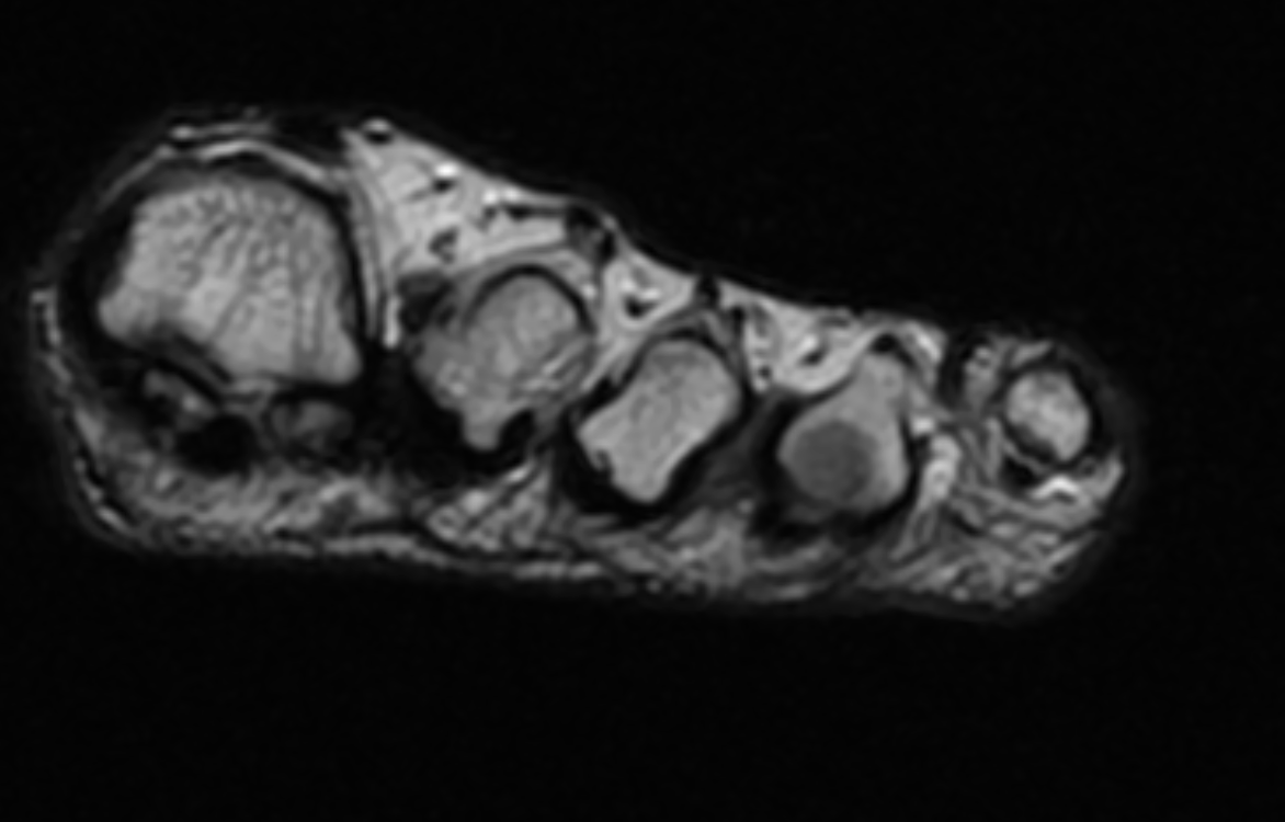 <p>Coronal T1 Image, Morton Neuroma