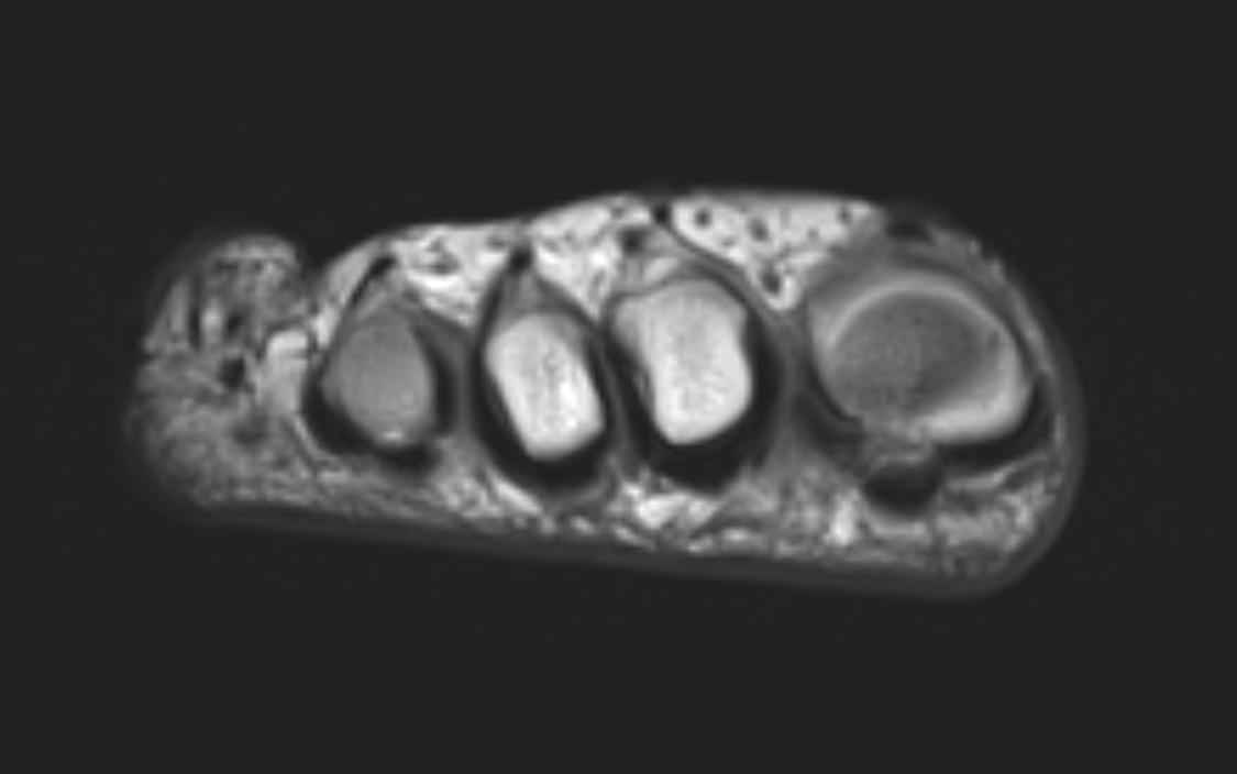 <p>Coronal T1 MRI Morton Neuroma. Scan demonstrates a Morton neuroma between the third and fourth metatarsals.</p>