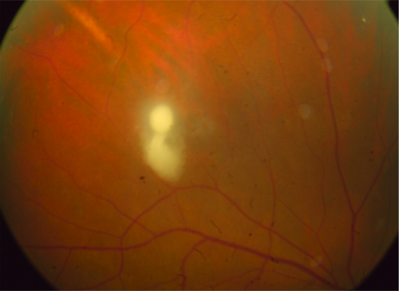 Raised chorioretinal Candida lesion in the active phase.