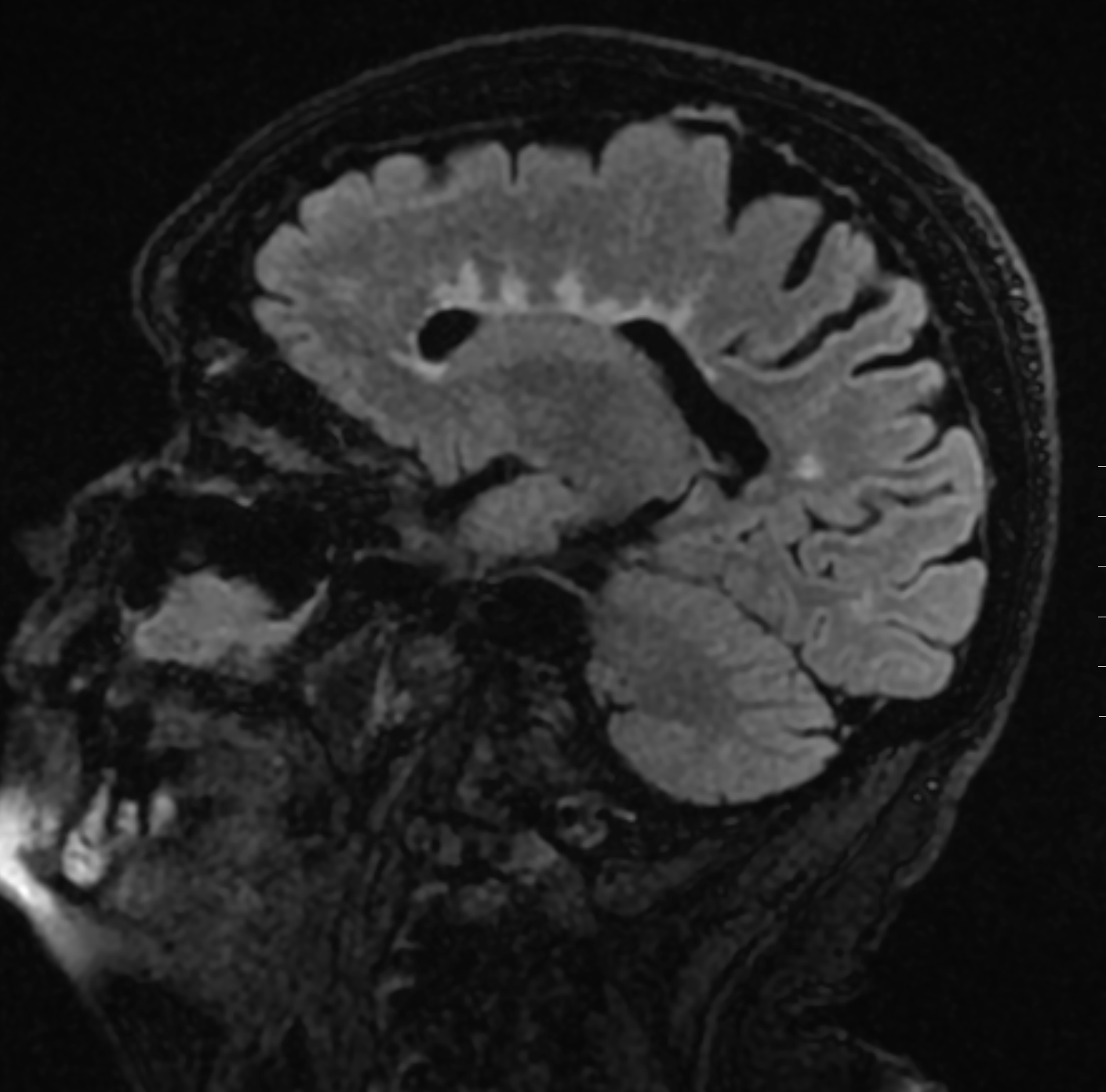 <p>Sagittal FLAIR MRI Brain Image Demonstrating Linear Hyperintense Lesions