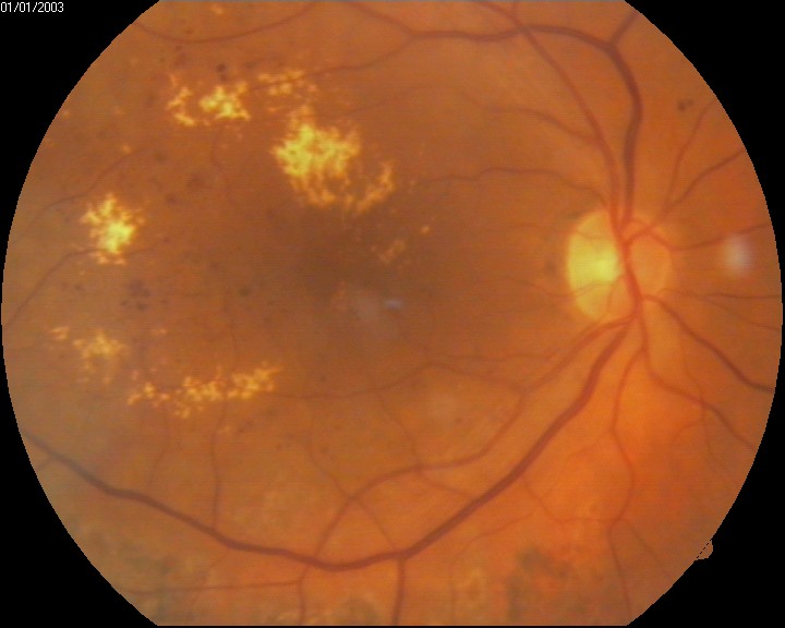 <p>Macular Edema Associated With Diabetes.</p>