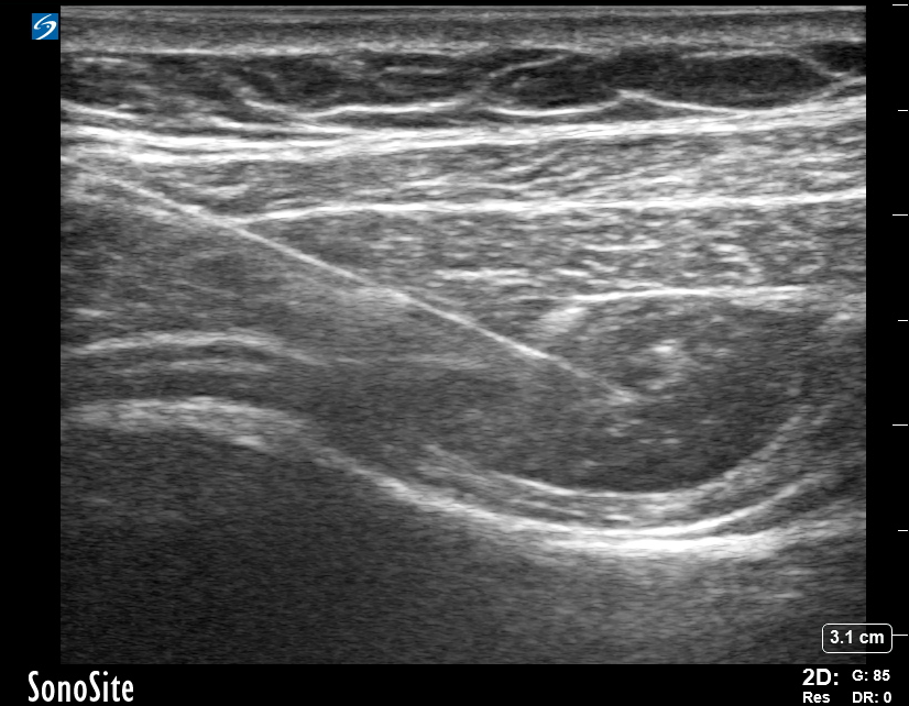 <p>Hydrodissection of TAP Compartment