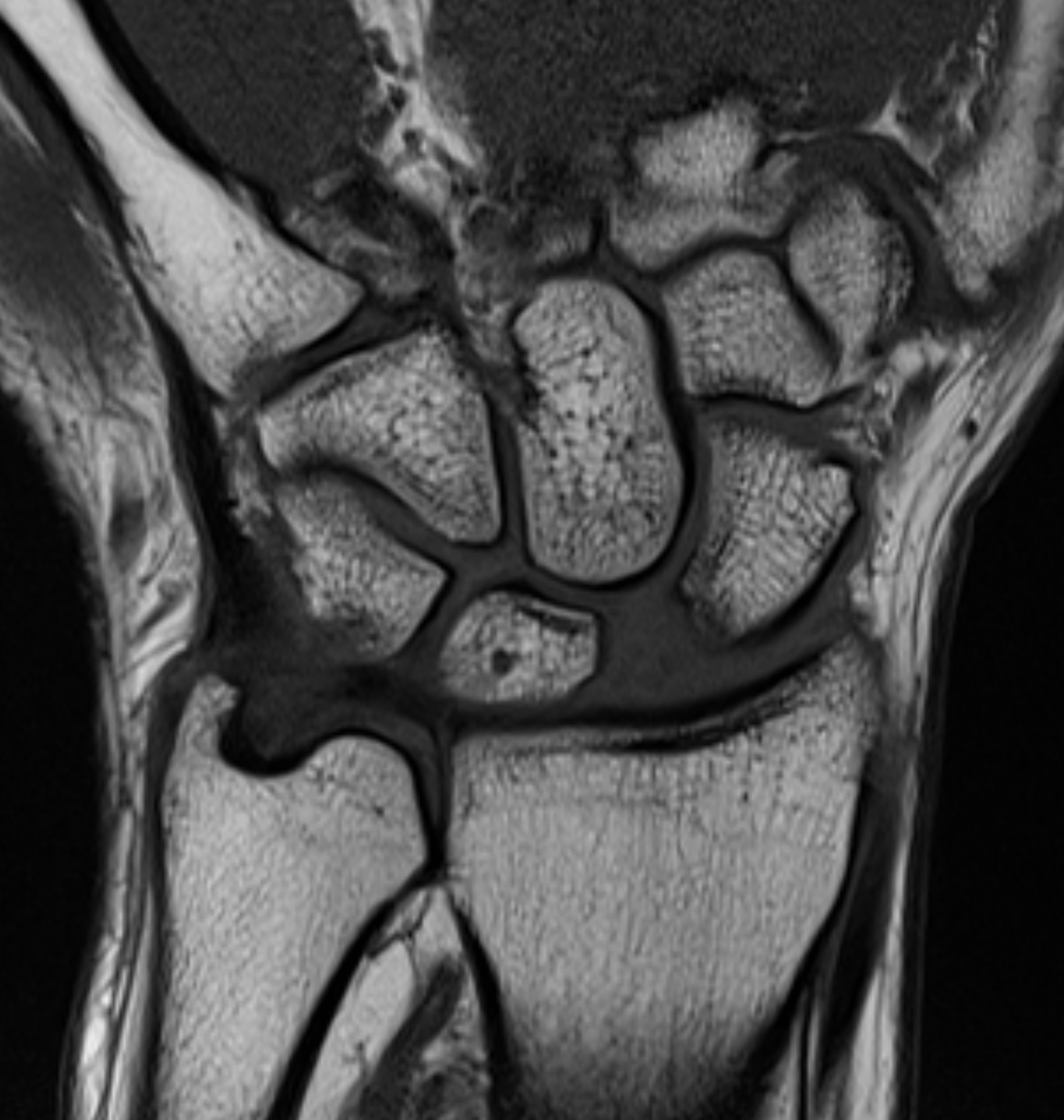 <p>Scapholunate Ligament Tear T1 Sequence. Coronal T1 sequence demonstrating a scapholunate ligament tear.</p>