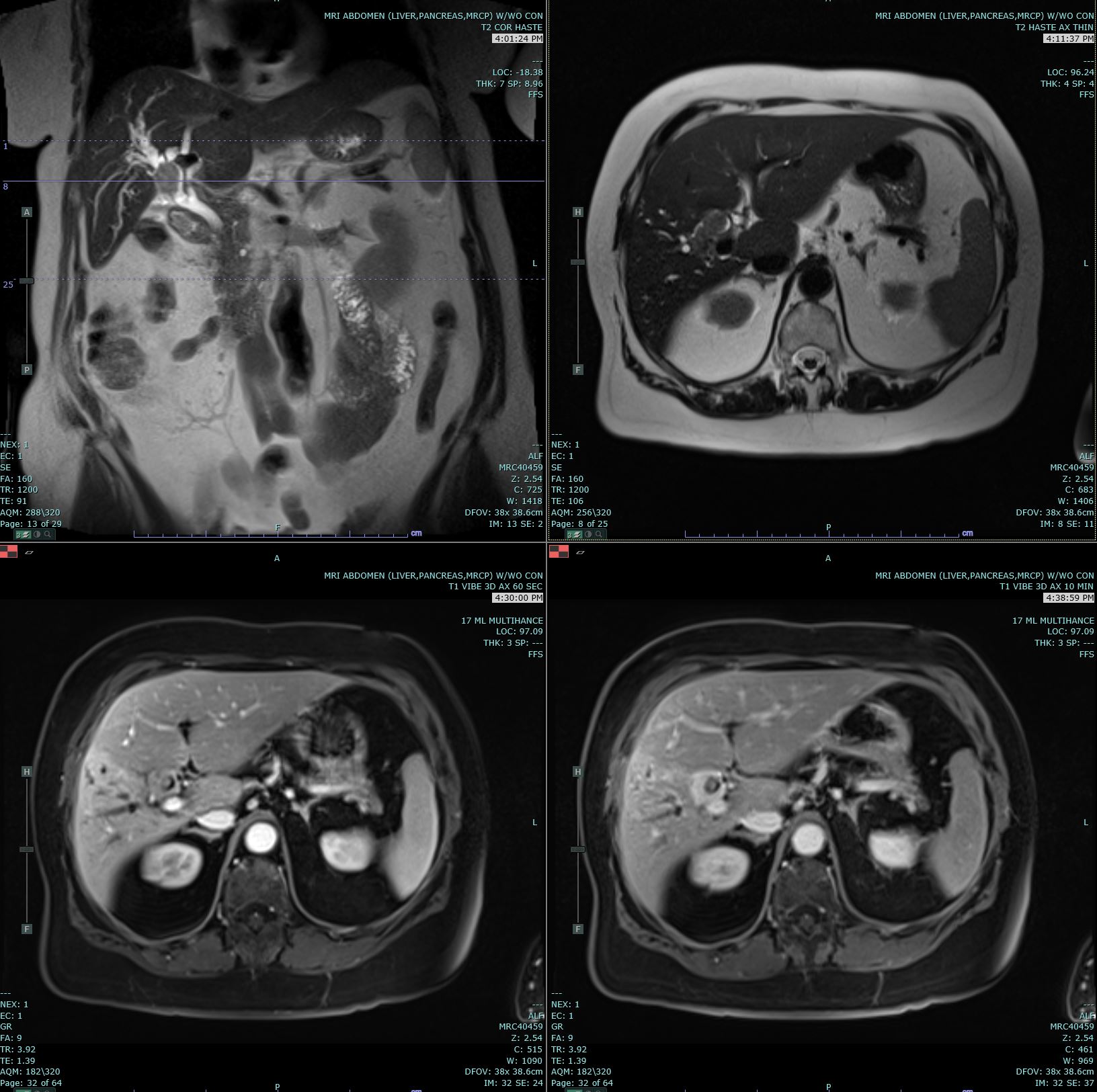 Coronal T2 Haste, Axial T2 Haste and 60 and 10 minute post contrast T1 Vibe images are submitted