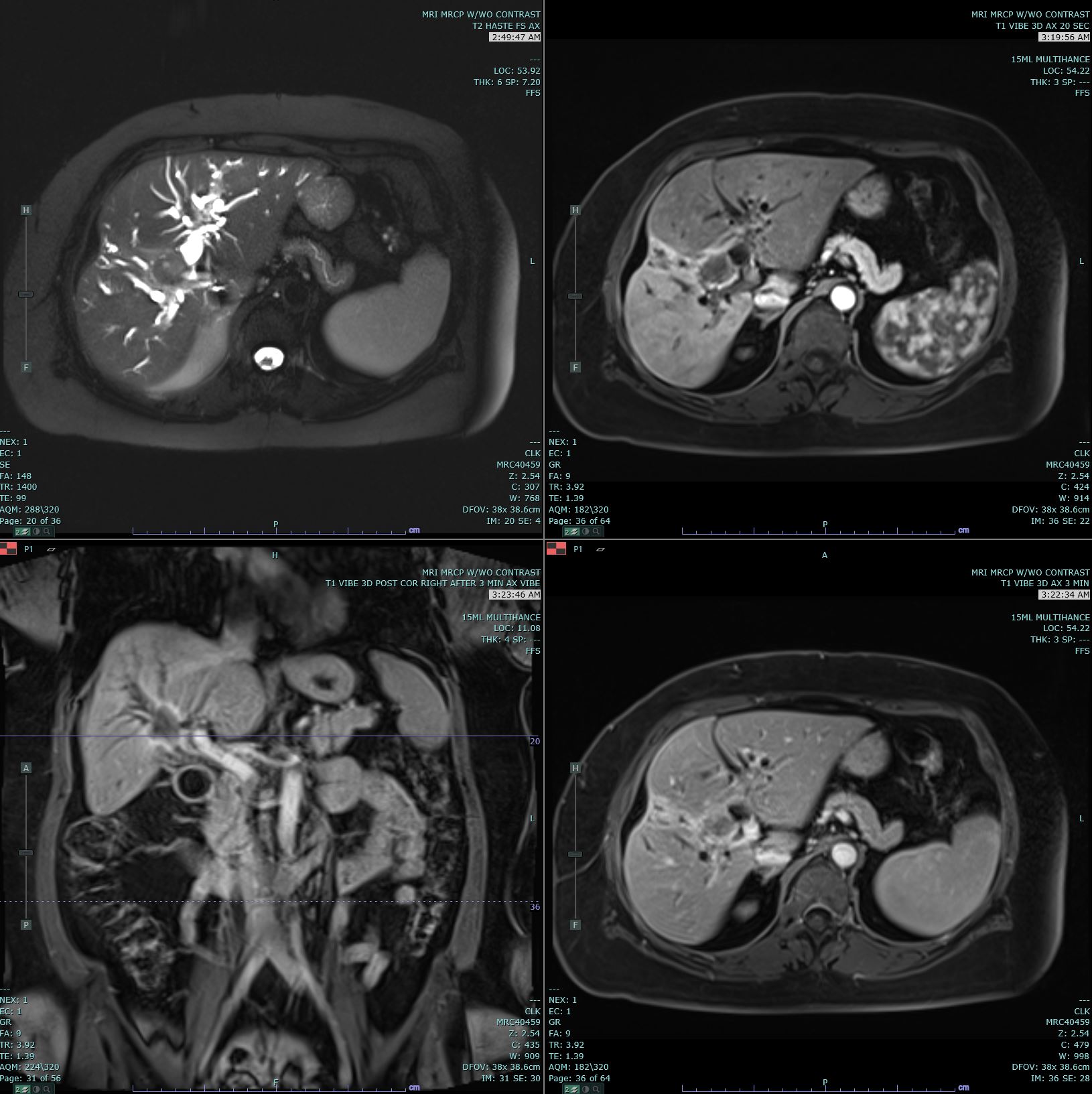 Axial T2 Haste, and 20s, and 3 minute post contrast T1 Vibe images are submitted