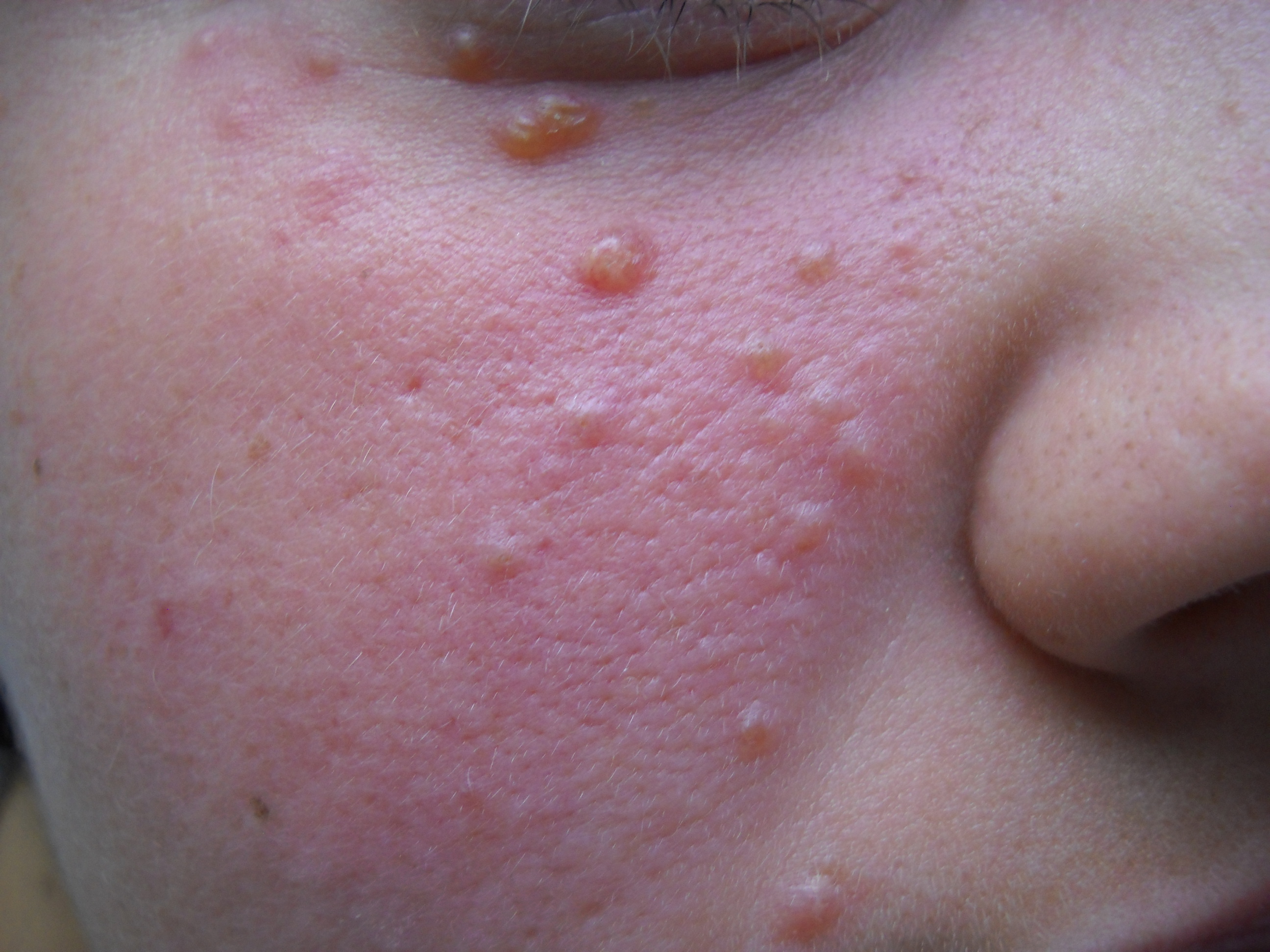 <p>Erythematous Papulonodules, Facial Eruption. Note eyelid involvement.</p>