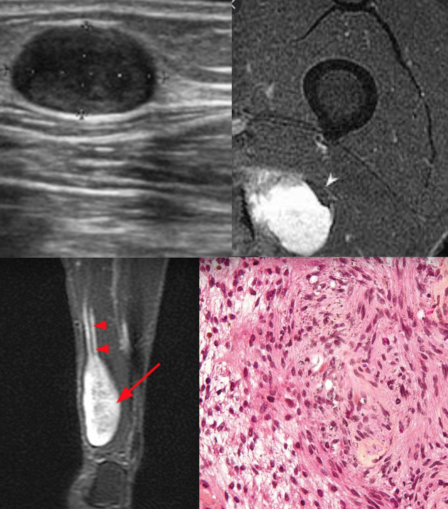 Neurilemmomas