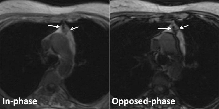 Thymic hyperplasia in a 40-year-old woman with myasthenia gravis.