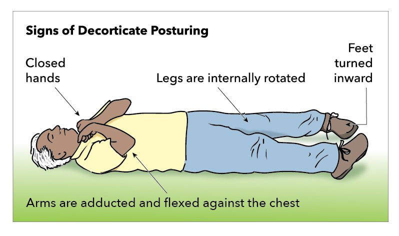 Decorticate Posturing