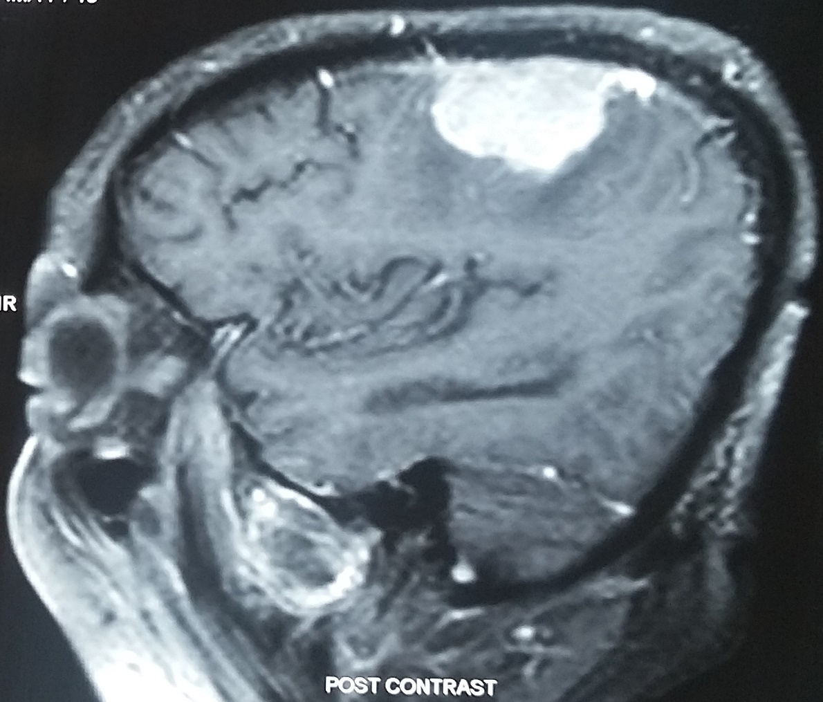 <p>Parietal Meningioma Causing Contralateral Sensory Syndrome</p>