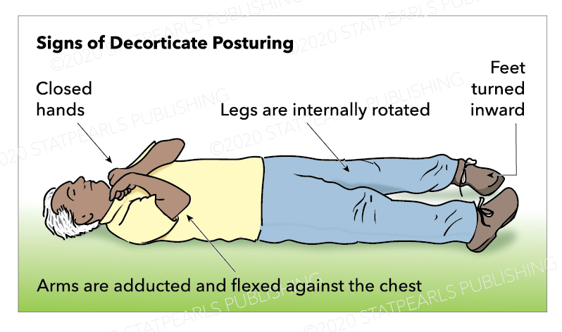 Decorticate Posturing