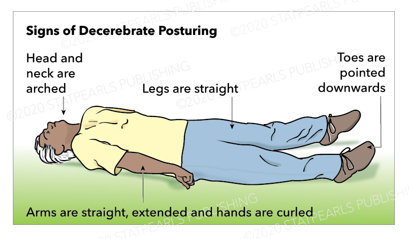 <p>Decerebrate Posturing</p>