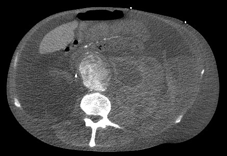 <p>Ruptured Abdominal Aortic Aneurysm</p>