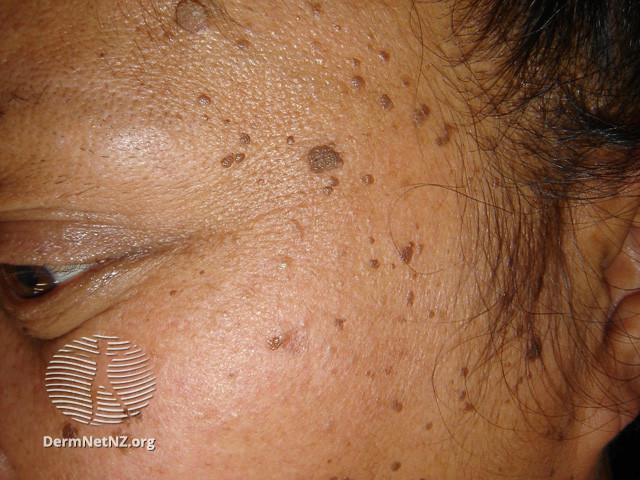 <p>Dermatosis Papulosa Nigra</p>