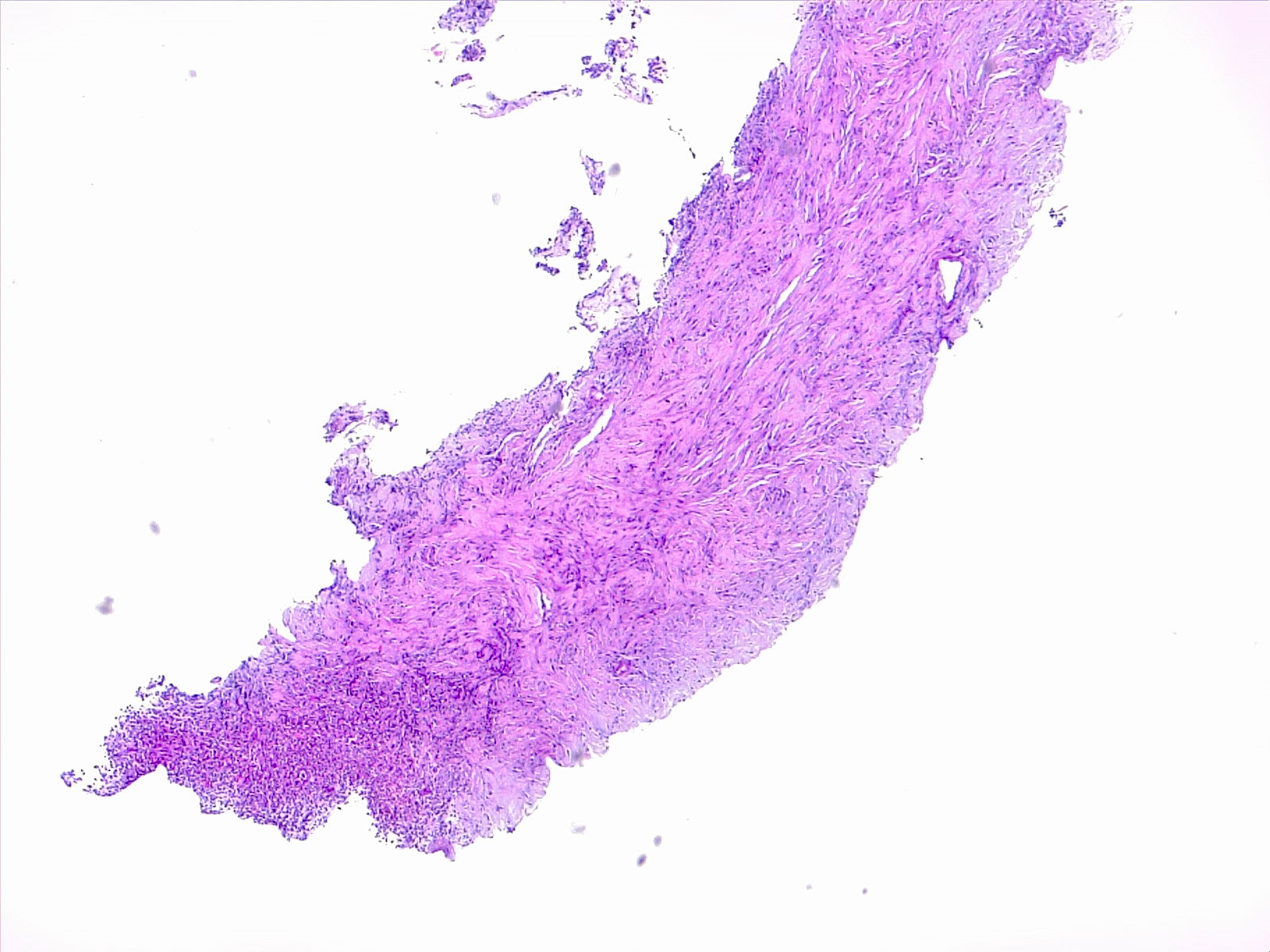 <p>Lung Pneumonia With Fibrosis.</p>