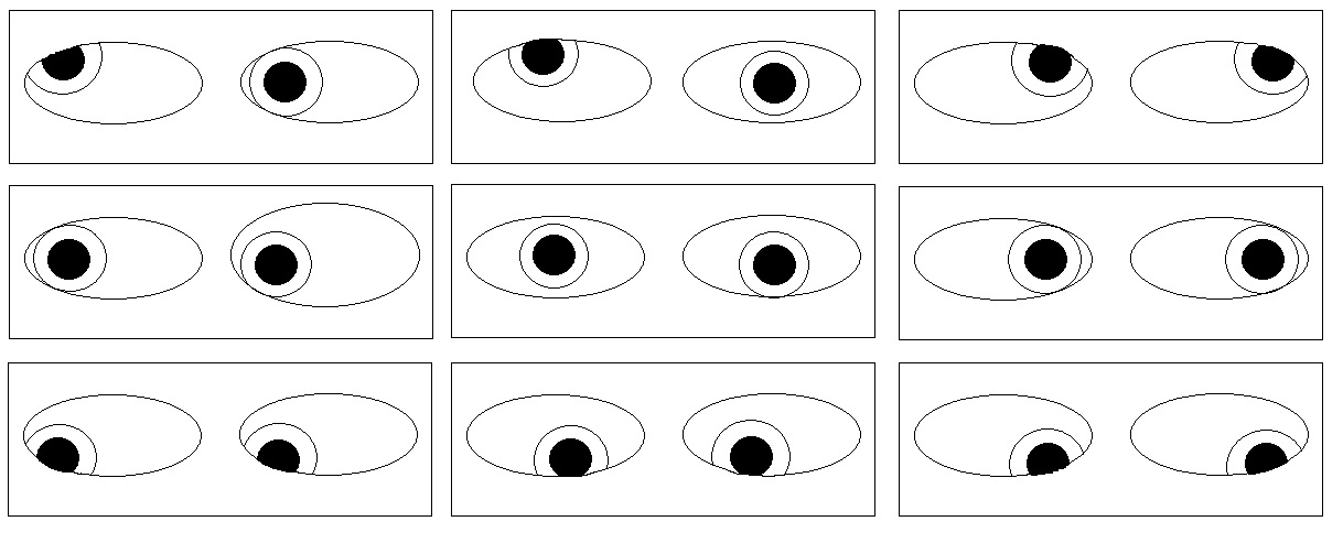 Left Brown syndrome with hypotropia in the primary position, limited elevation and downshoot in adduction.