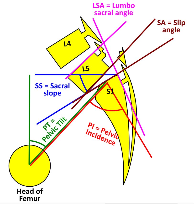 Spondylolysis with Spondylolisthesis, showing spino pelvic parameters, slip, dysplasia of upper endplate of S1, Slip angle (SA = angle between inferior endplate of L5 and line perpendicular to the S1 posterior wall) and lumbo sacral angle (LSA = angle between the superior endplate of L5 and posterior wall of the S1)