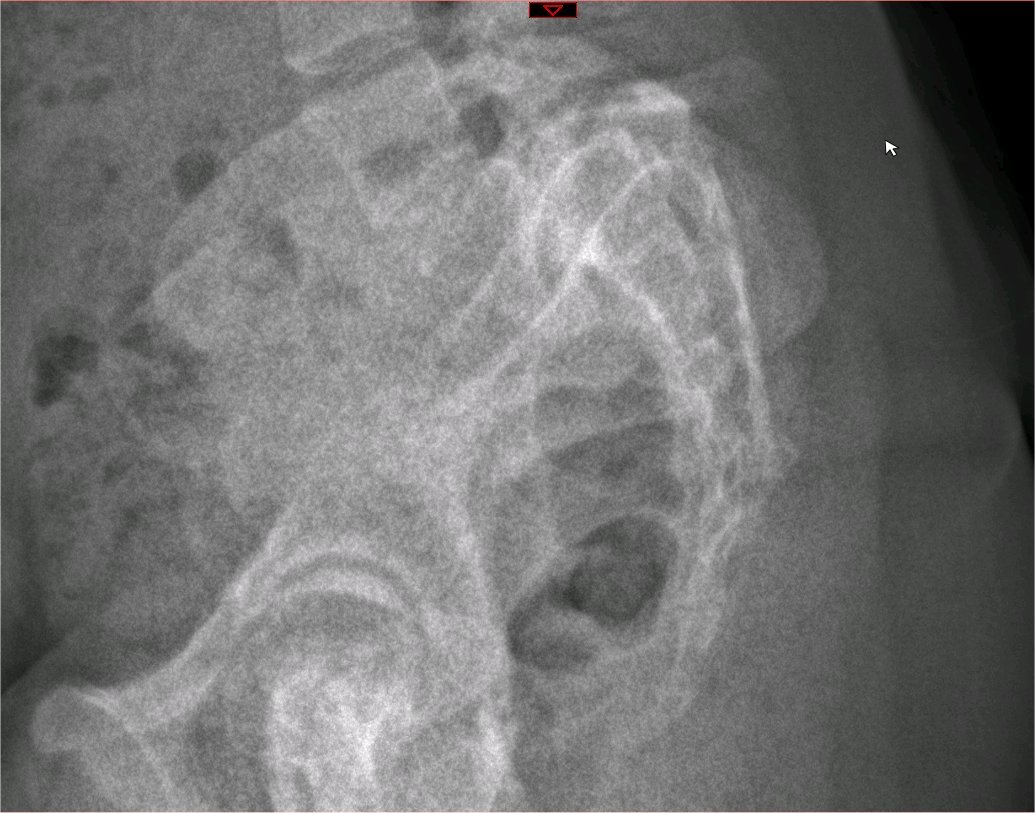 Lateral X-ray of the pelvis and lower lumbar spine showing spondylolysis and spondylolisthesis.