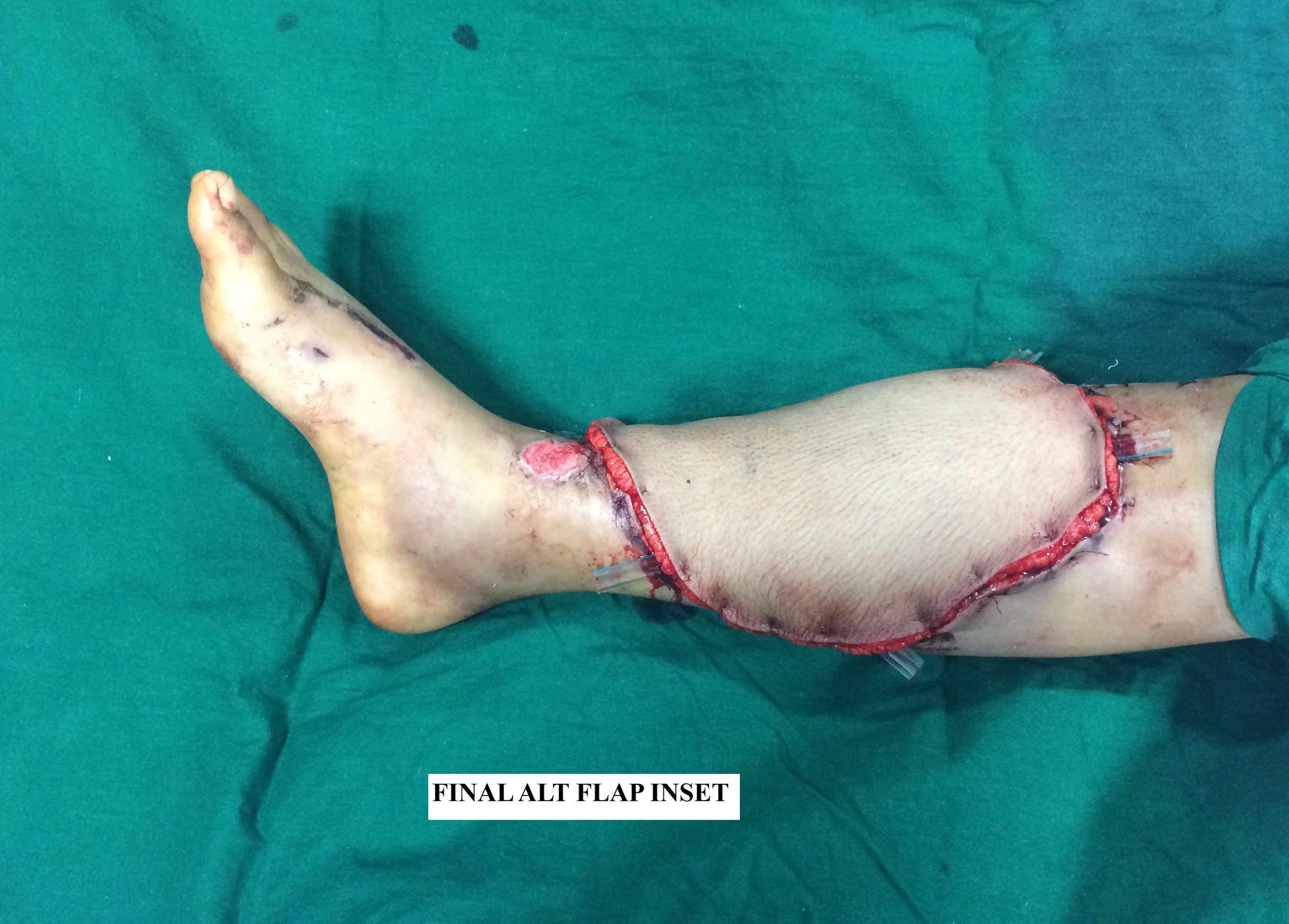 ALT FLAP FINAL INSET OVER LEG DEFECT